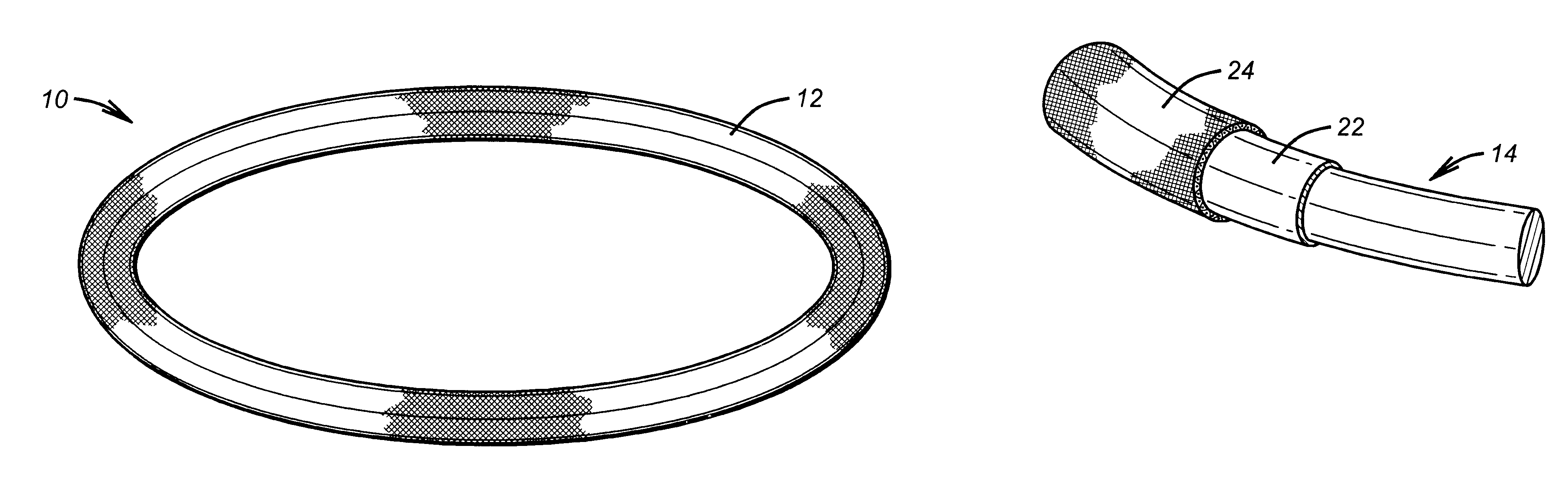 Antithrombogenic annuloplasty ring having a biodegradable insert