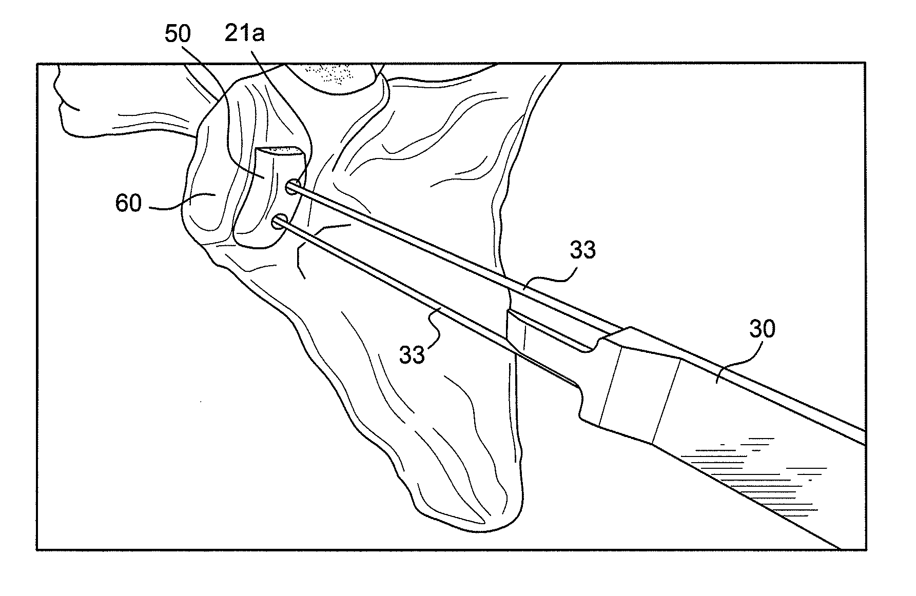 Latarjet instrumentation and method