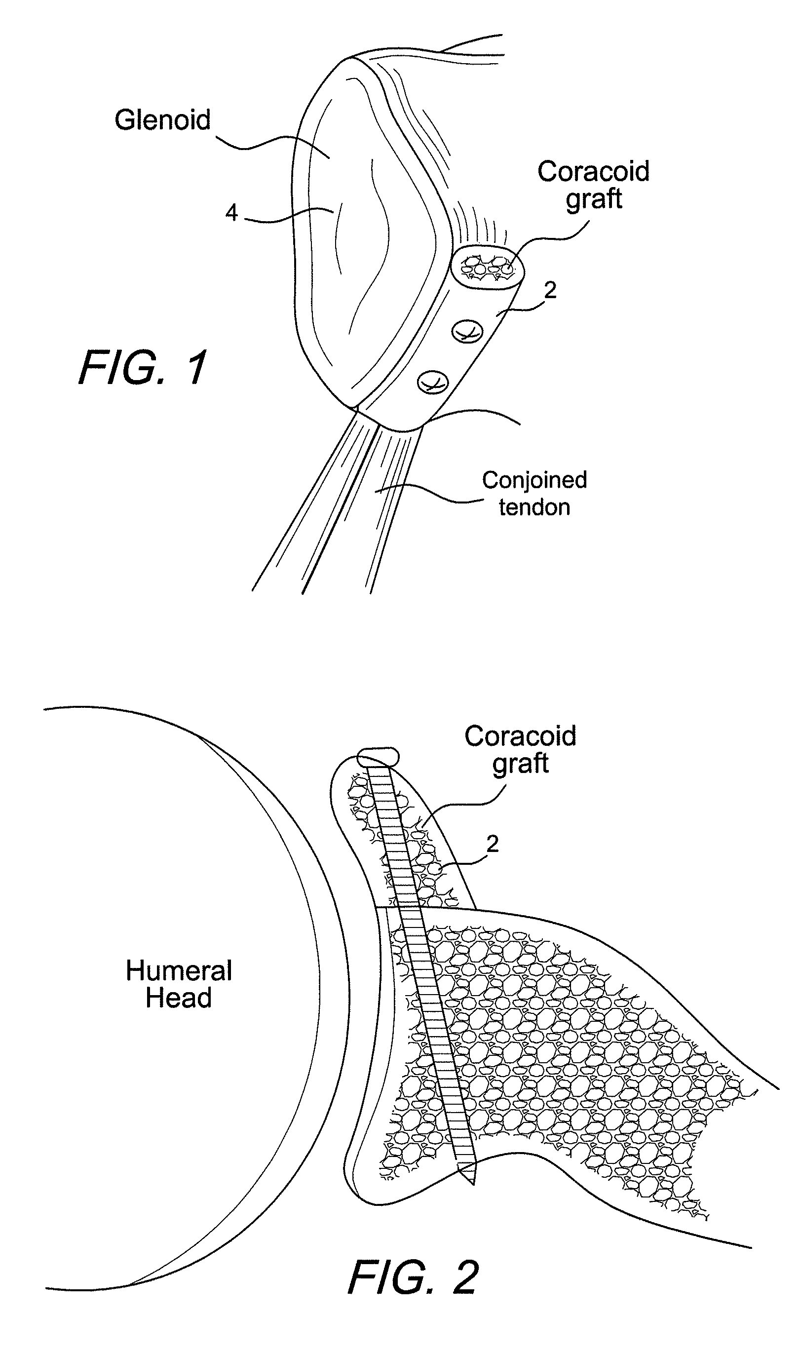 Latarjet instrumentation and method