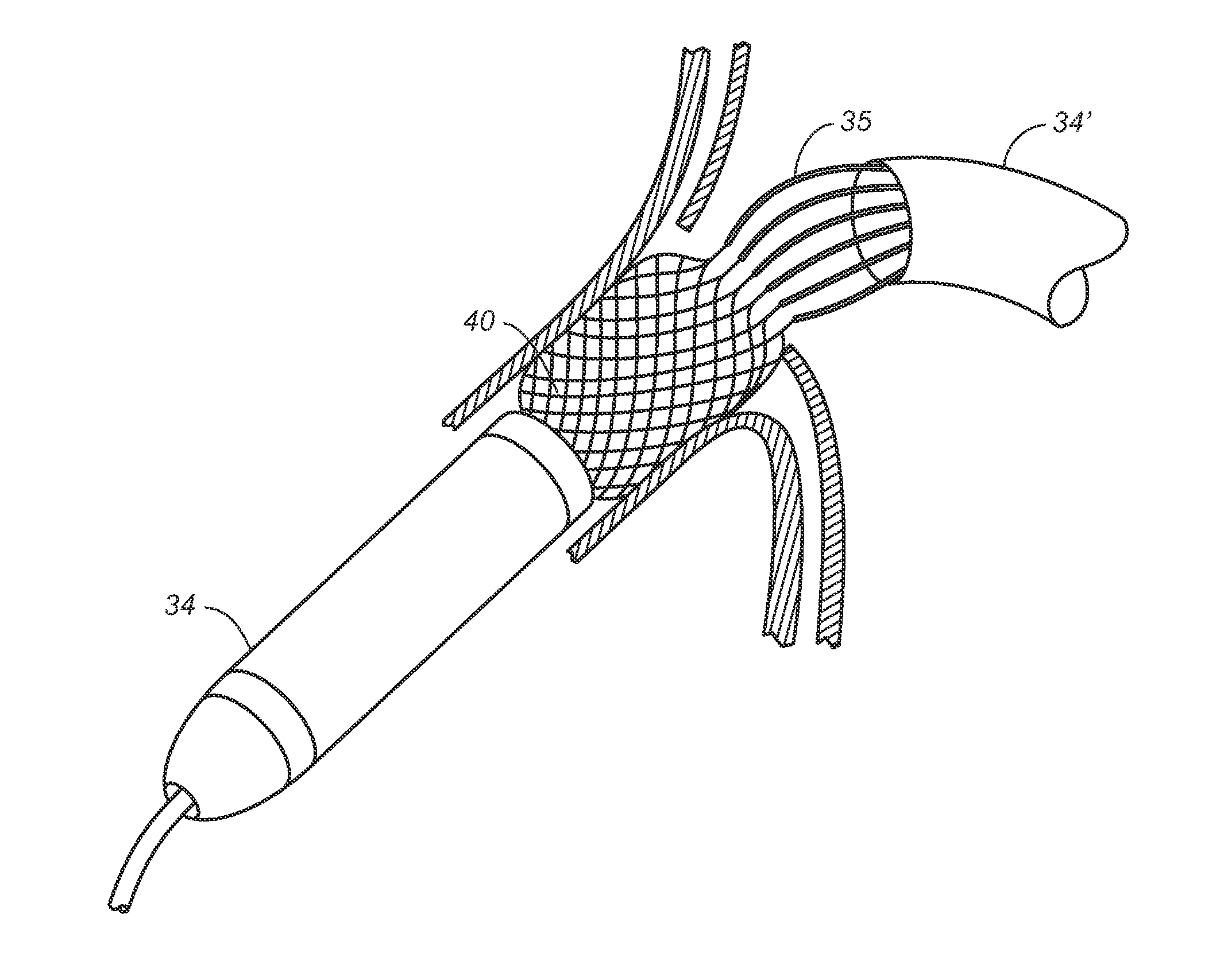 Branch Vessel Suture Stent System and Method