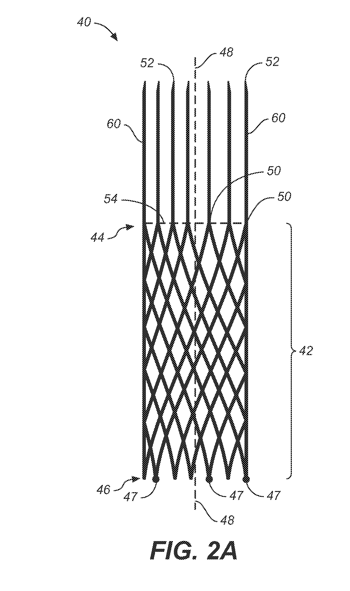 Branch Vessel Suture Stent System and Method