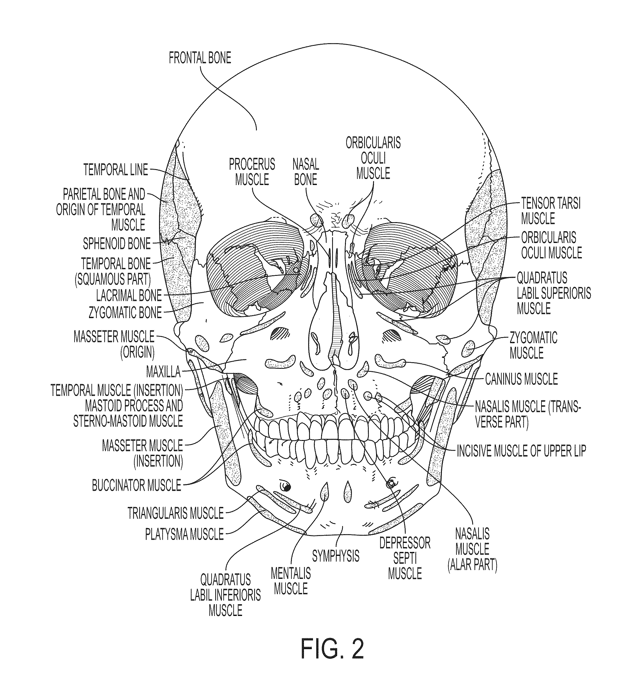 Submuscular Facial Fixation (Myo-Osseous Fixation) Using Microincision Microscrew Device, Injectable Glues and Adhesives, and Method and Device for Therapy of Migraine and Related Headaches