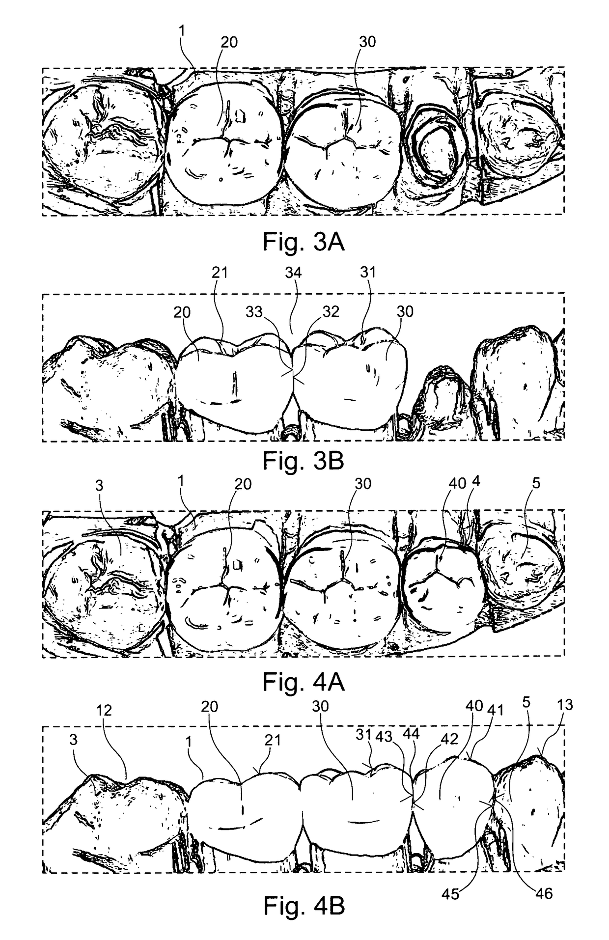 Method for designing a plurality of adjacent tooth restorations using CAD/CAM technology