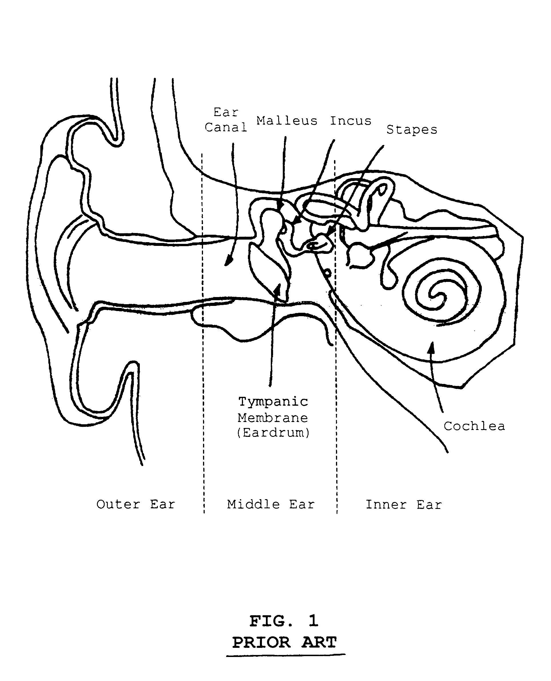 Stapedial prosthesis and method of implanting the same