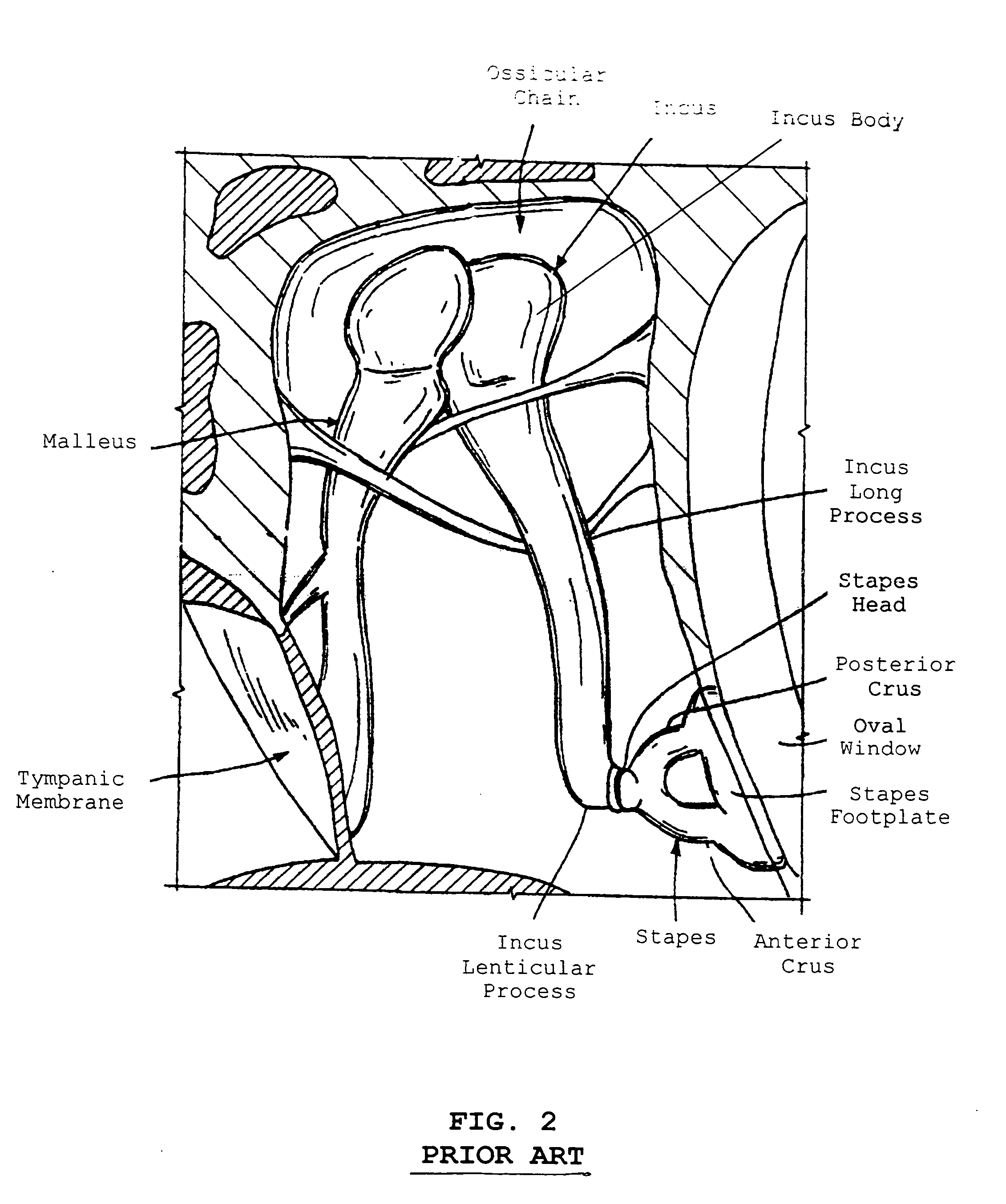 Stapedial prosthesis and method of implanting the same