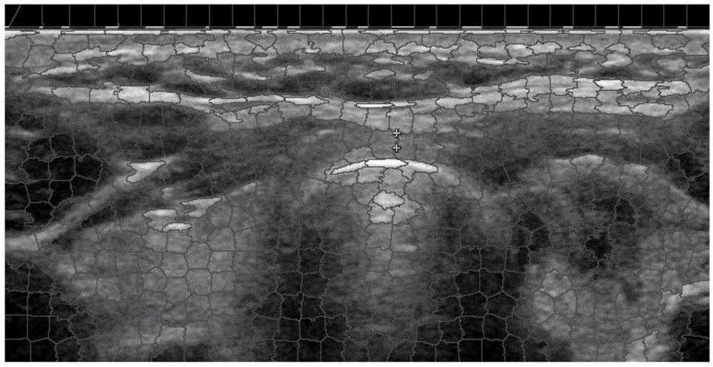 Ultrasonic image low-rank analysis based thyroid lesion image identification method