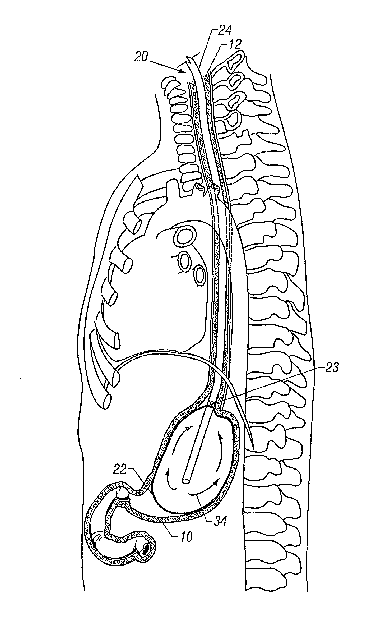 Apparatus and Method Of Gastric Cooling Using Balloon Catheter