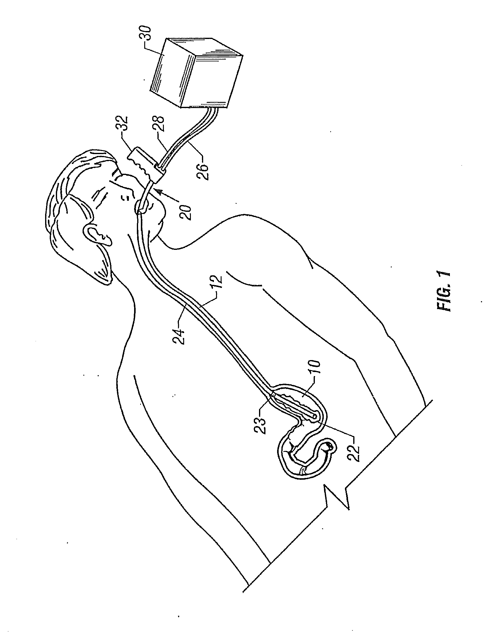 Apparatus and Method Of Gastric Cooling Using Balloon Catheter