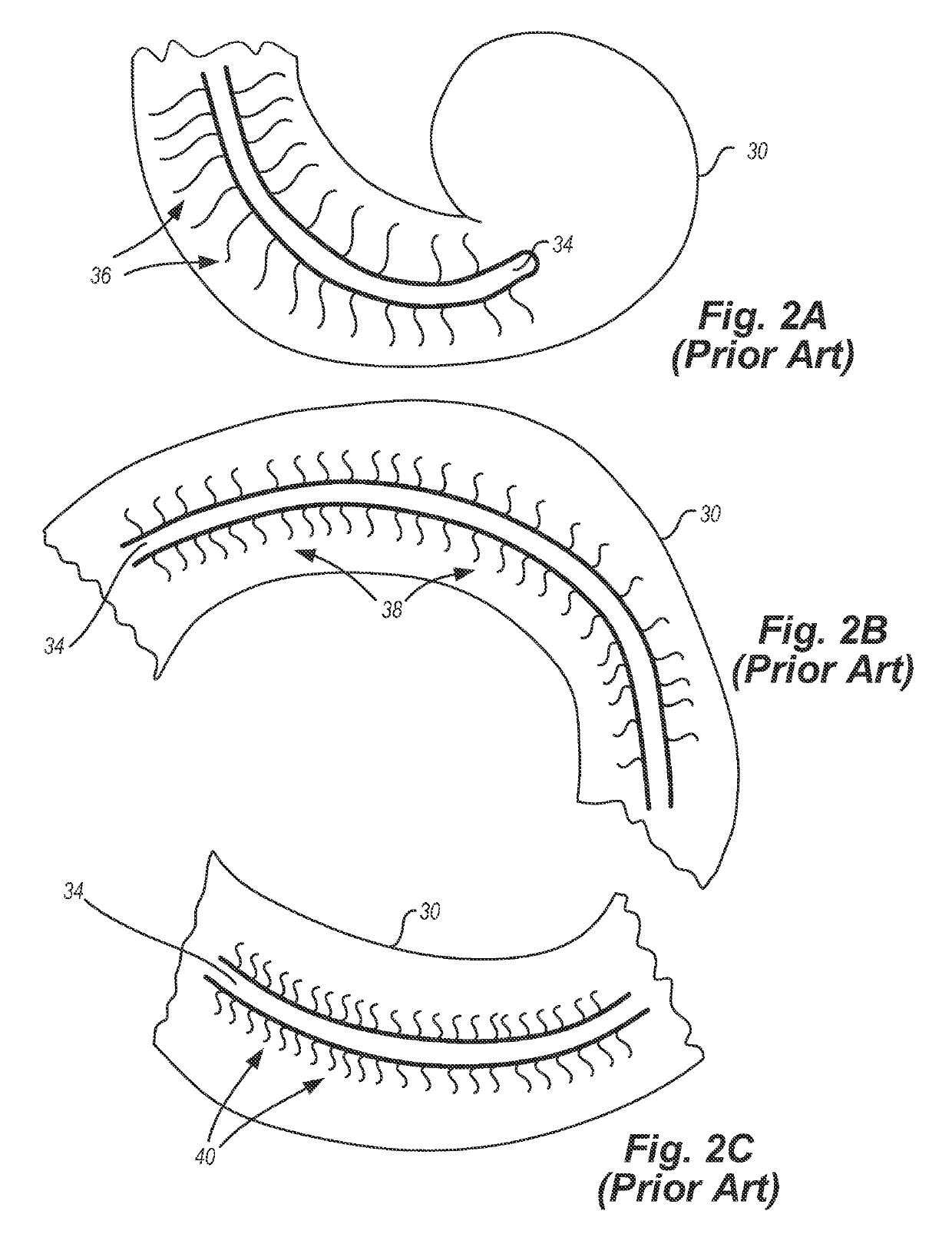 Localized therapeutic hypothermia system, device, and method