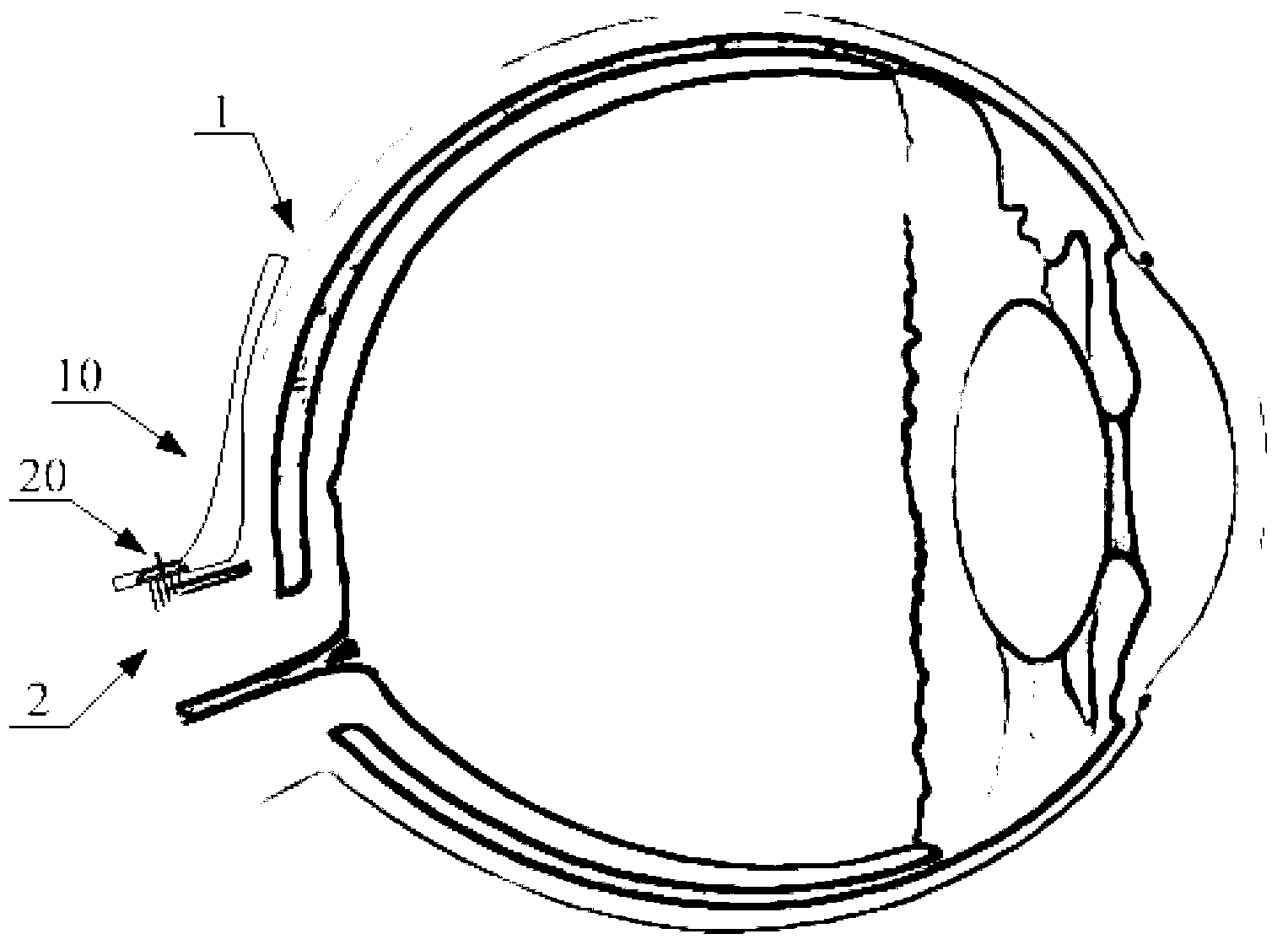 Optic nerve implantable neural interface device with fan-shaped attaching function