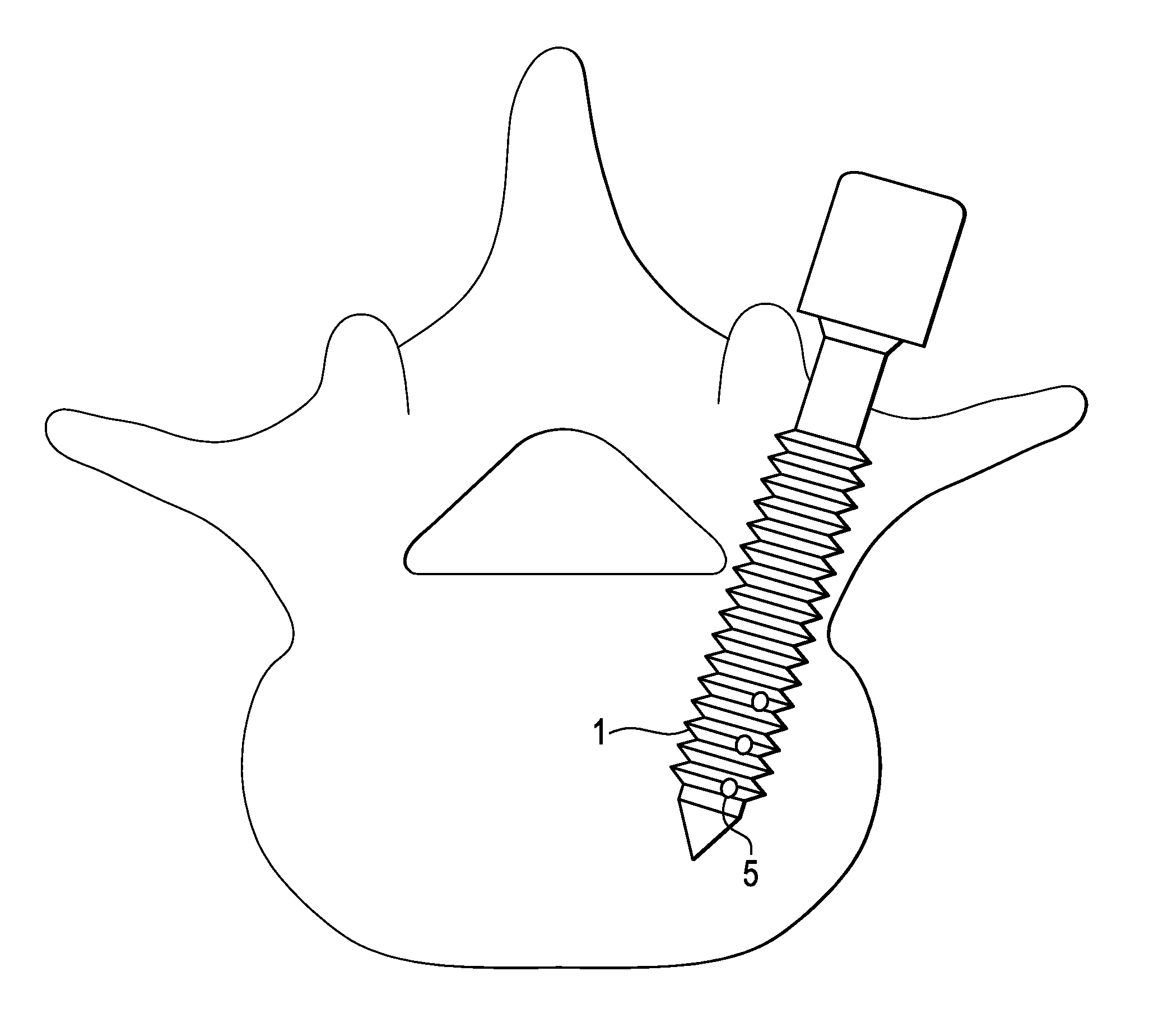 Methods and devices for correcting spinal deformity with pharmaceutical-eluting pedicle screws