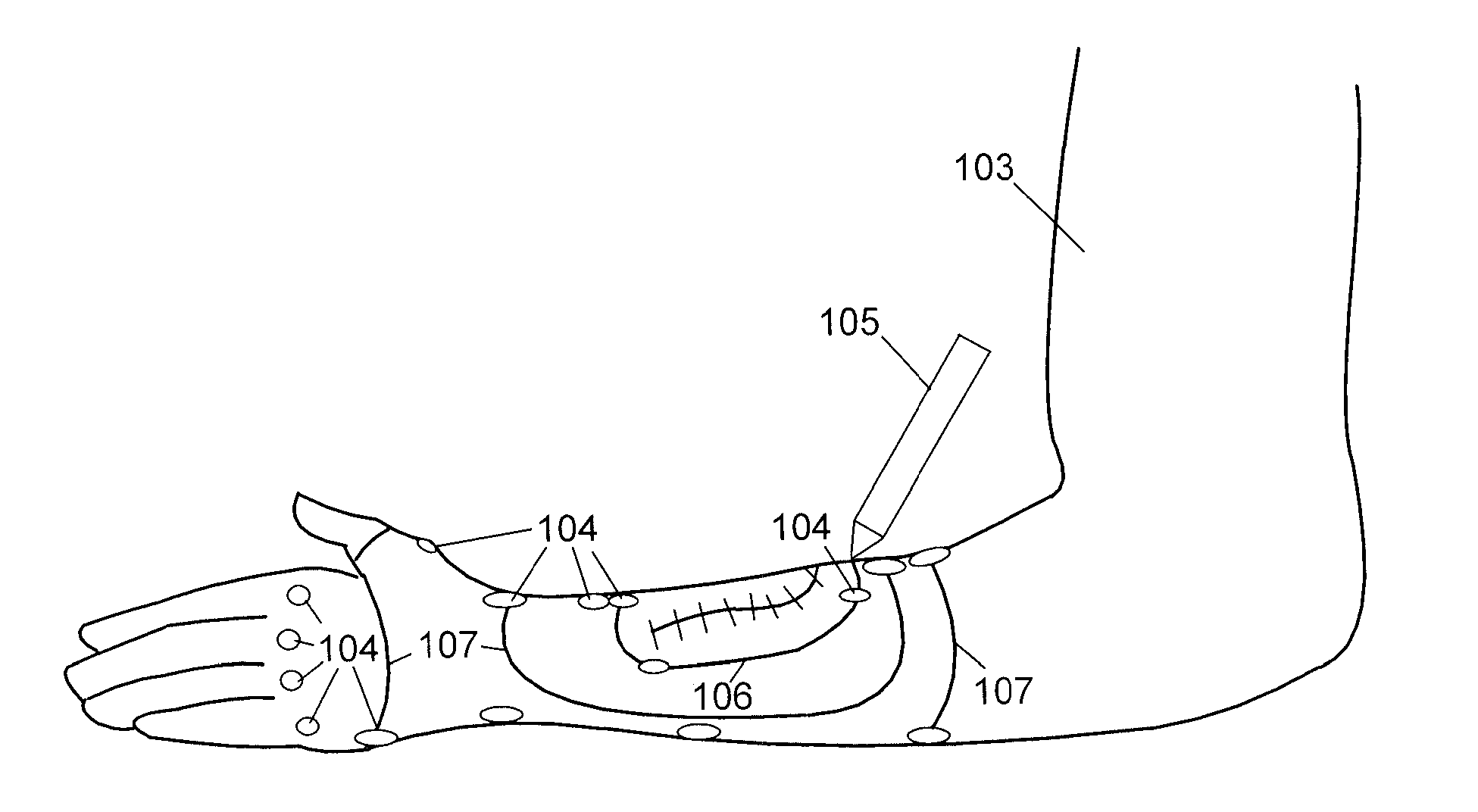 Brace with elongated fenestrations