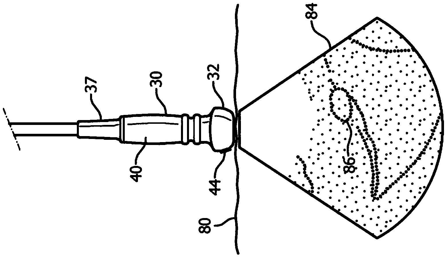 Ultrasonic Guidance Of A Needle Path During Biopsy