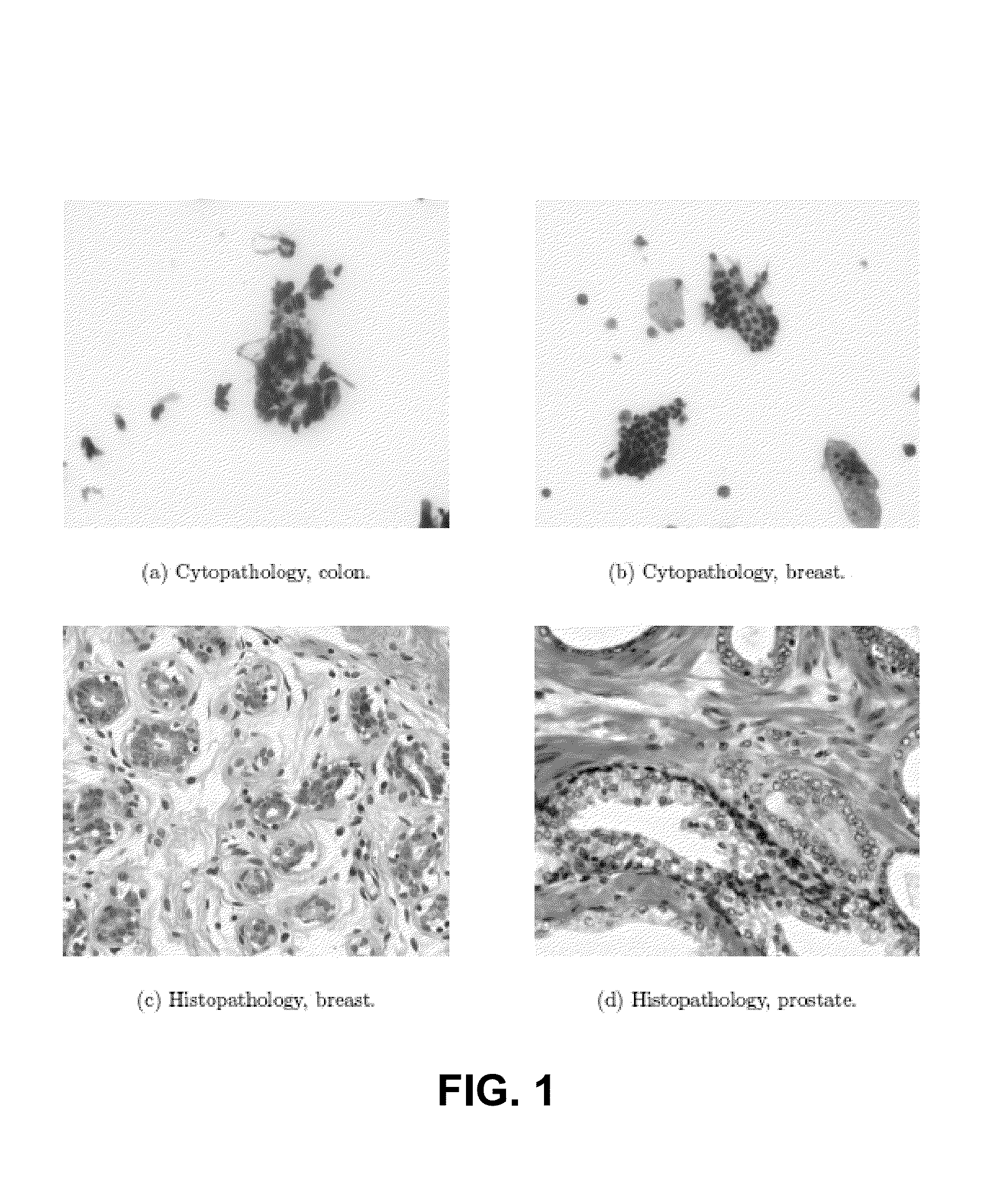 Combinational pixel-by-pixel and object-level classifying, segmenting, and agglomerating in performing quantitative image analysis that distinguishes between healthy non-cancerous and cancerous cell nuclei and delineates nuclear, cytoplasm, and stromal material objects from stained biological tissue materials