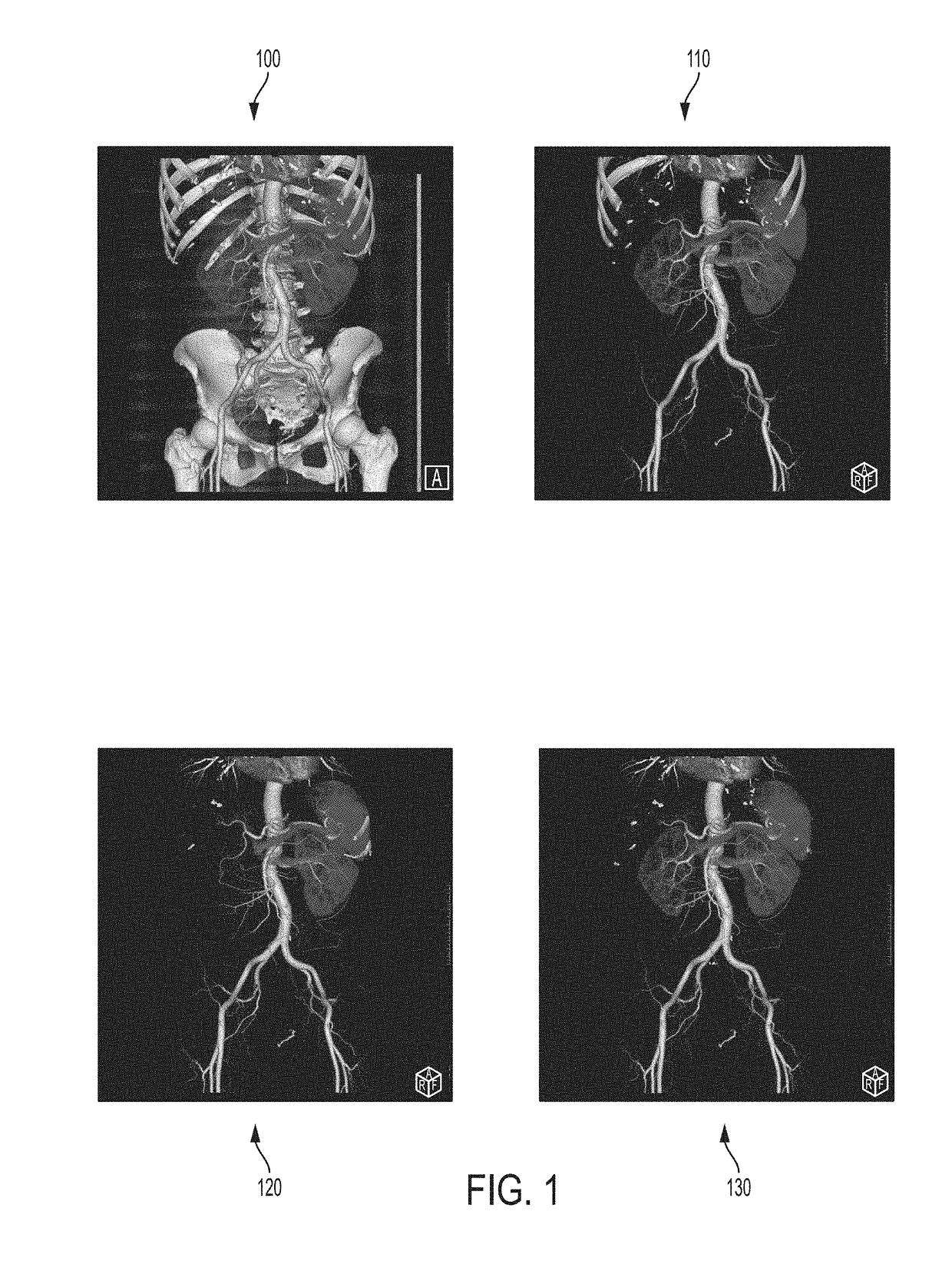 Deep Learning Based Bone Removal in Computed Tomography Angiography