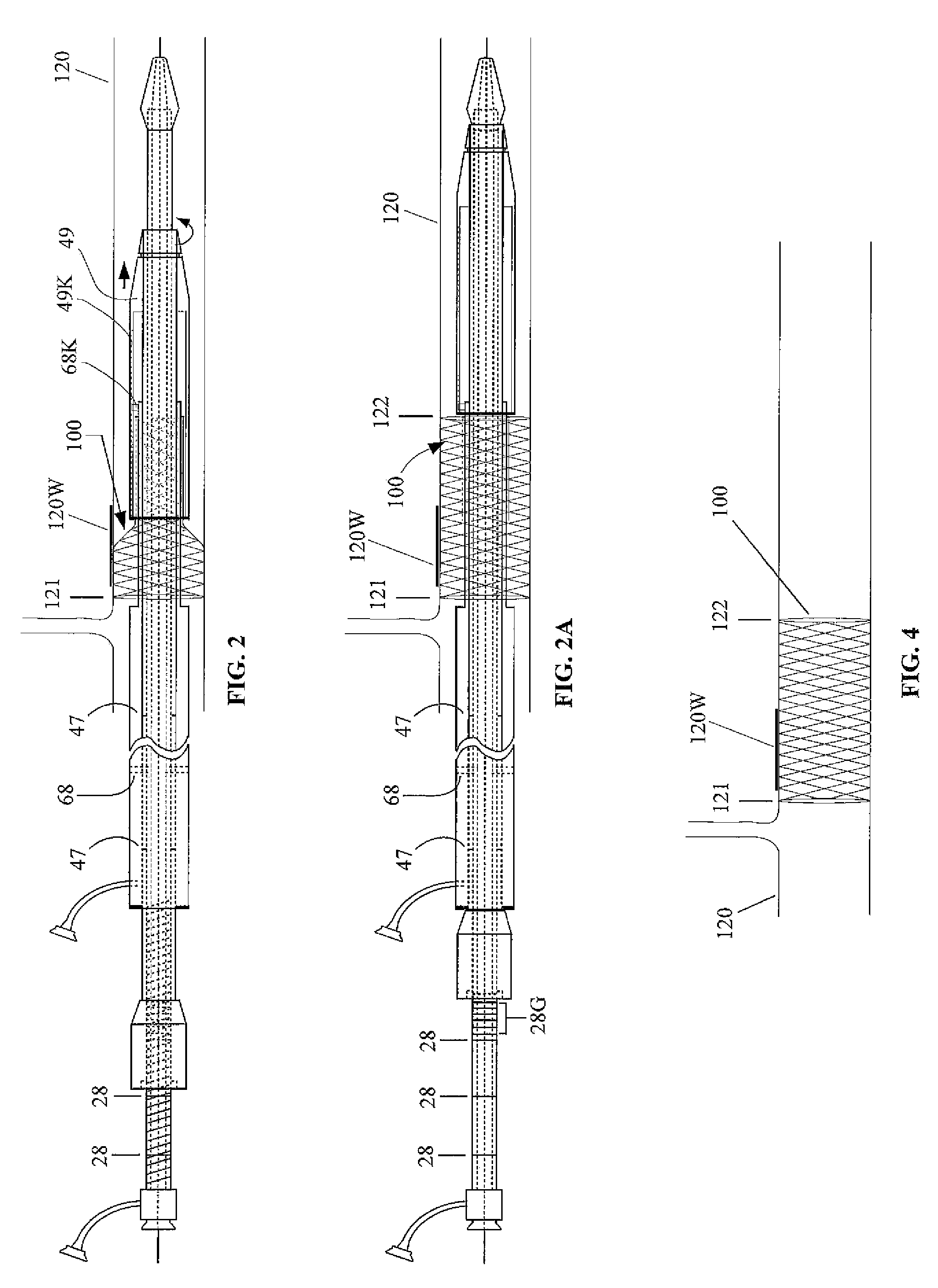 Apparatus And Method for Proximal-to-Distal Endoluminal Stent Deployment