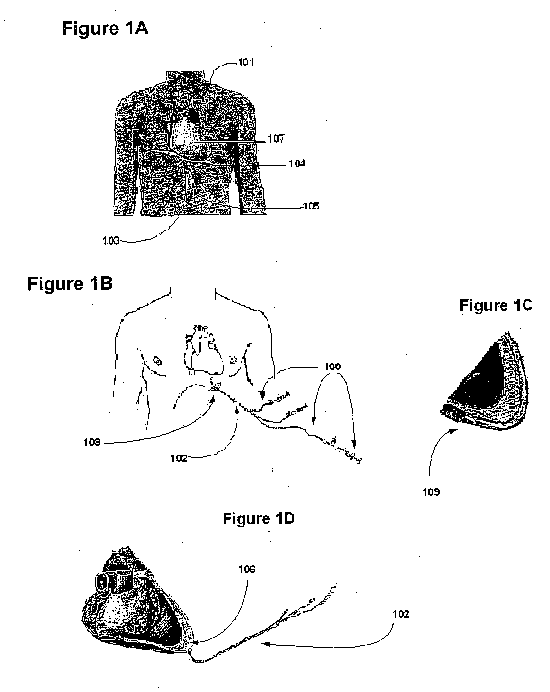 Biodegradable pericardia constraint system and method
