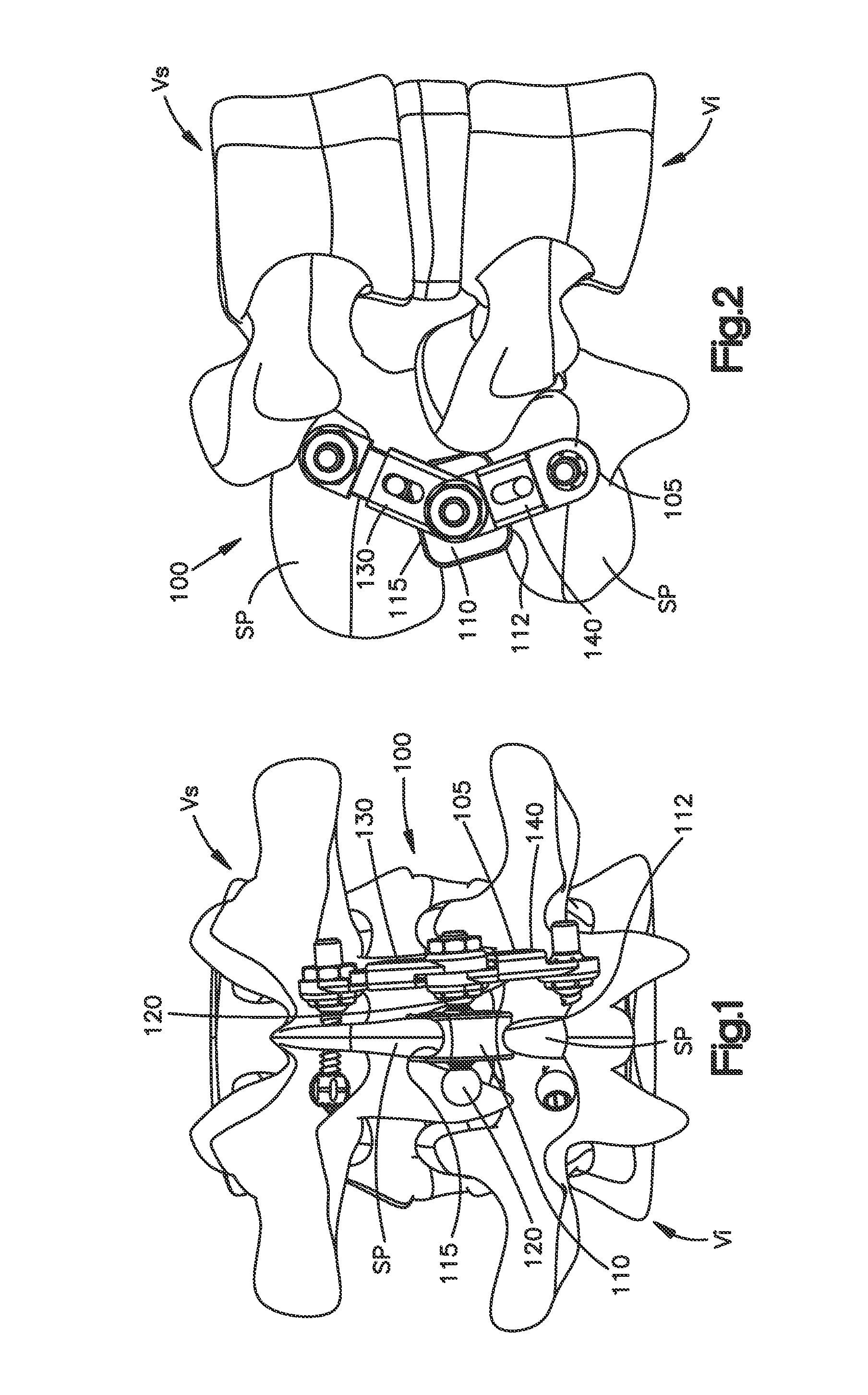 Interspinous spacer assembly