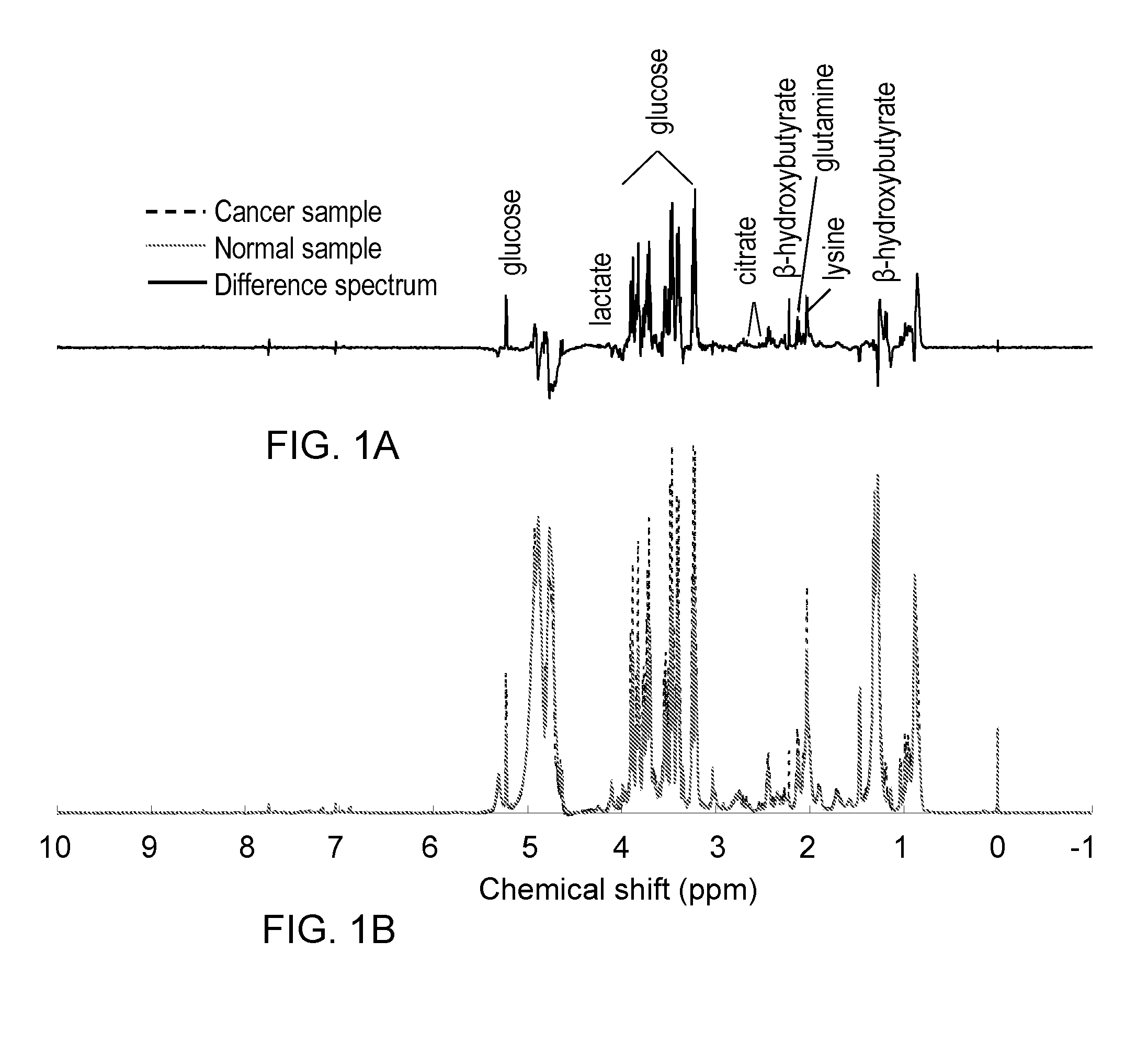 Metabolite Biomarkers for the Detection of Esophageal Cancer Using NMR