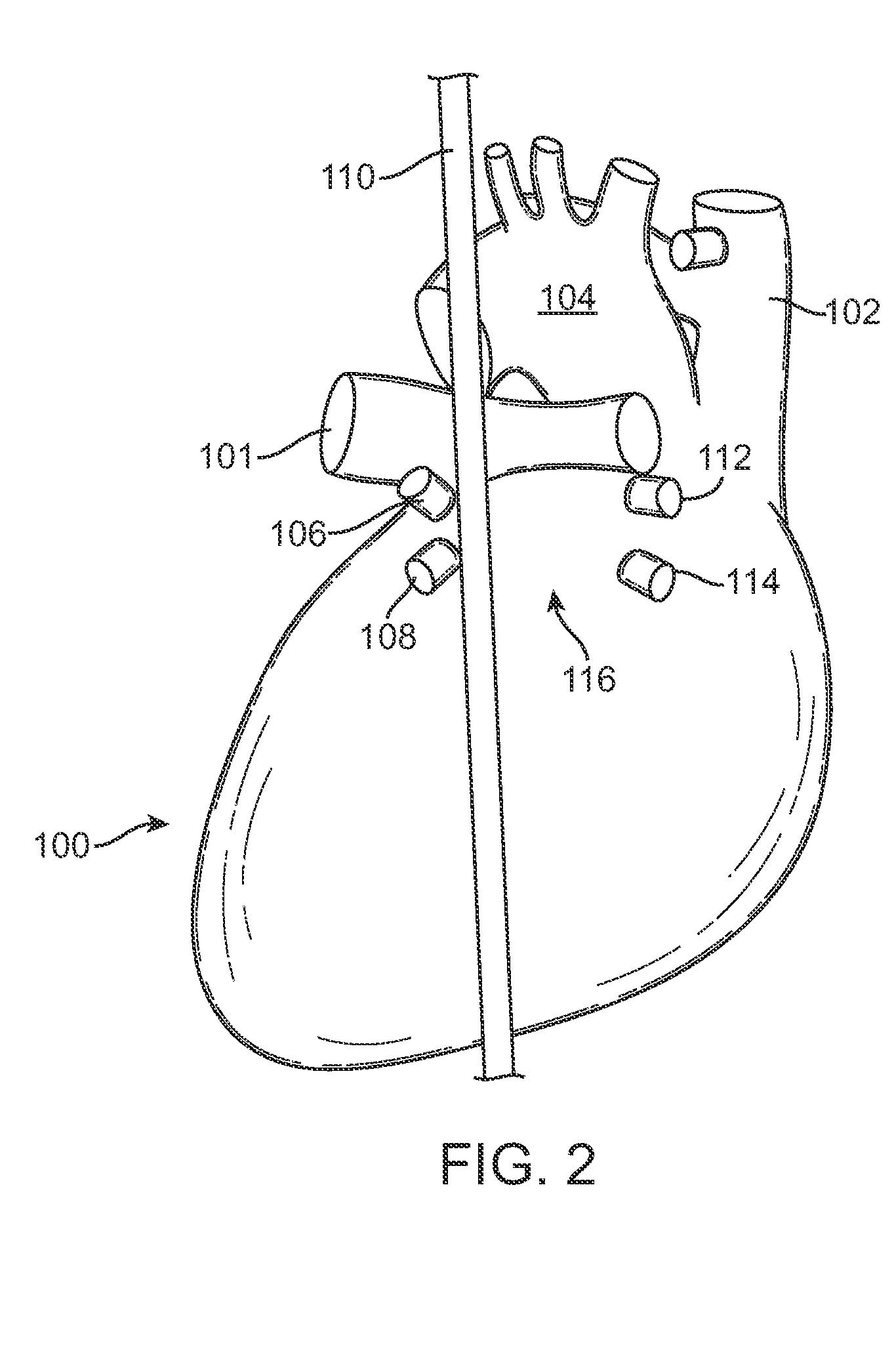 Method to protect the esophagus and other mediastinal structures during cardiac and thoracic interventions
