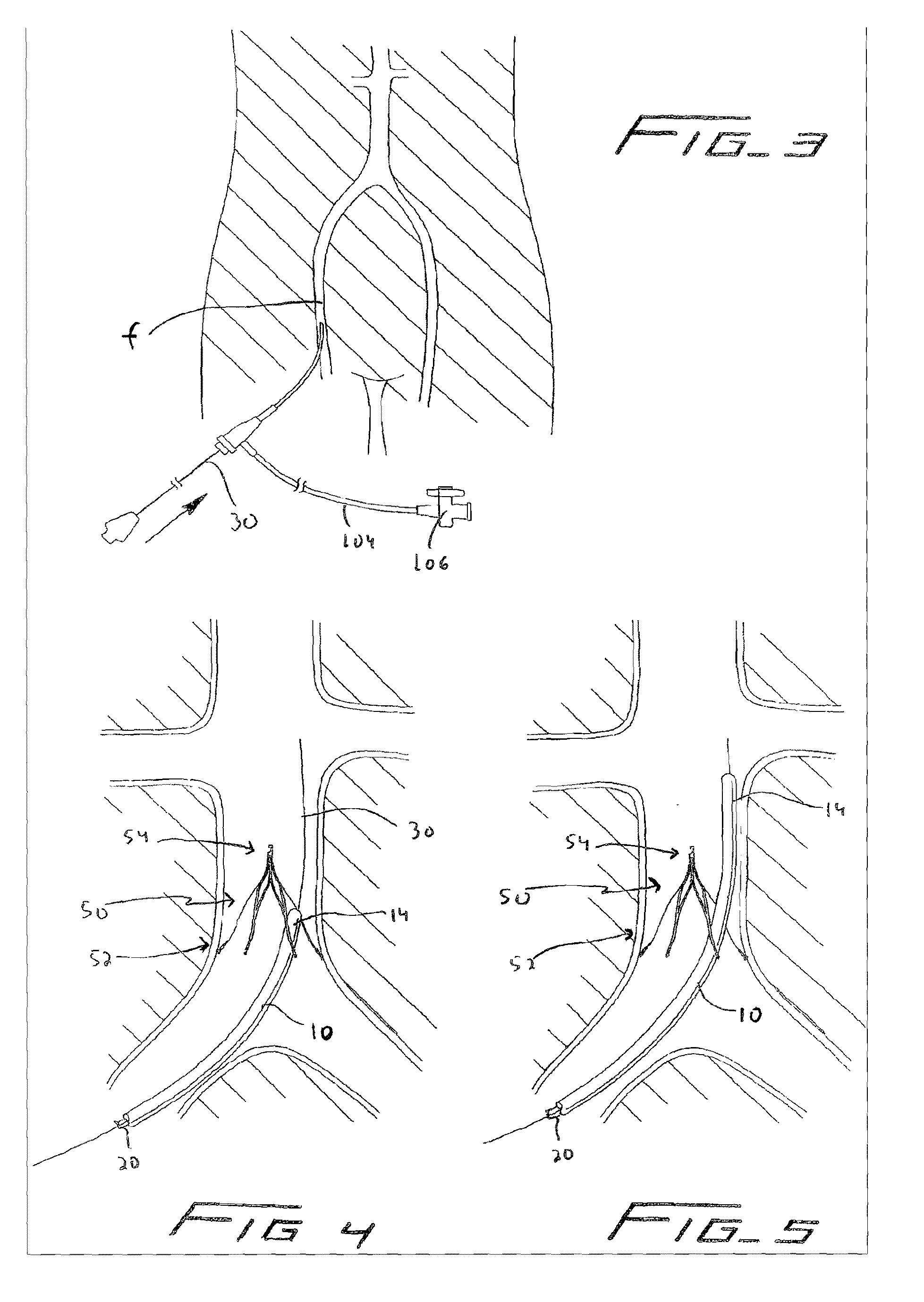 Method of removing a vein filter