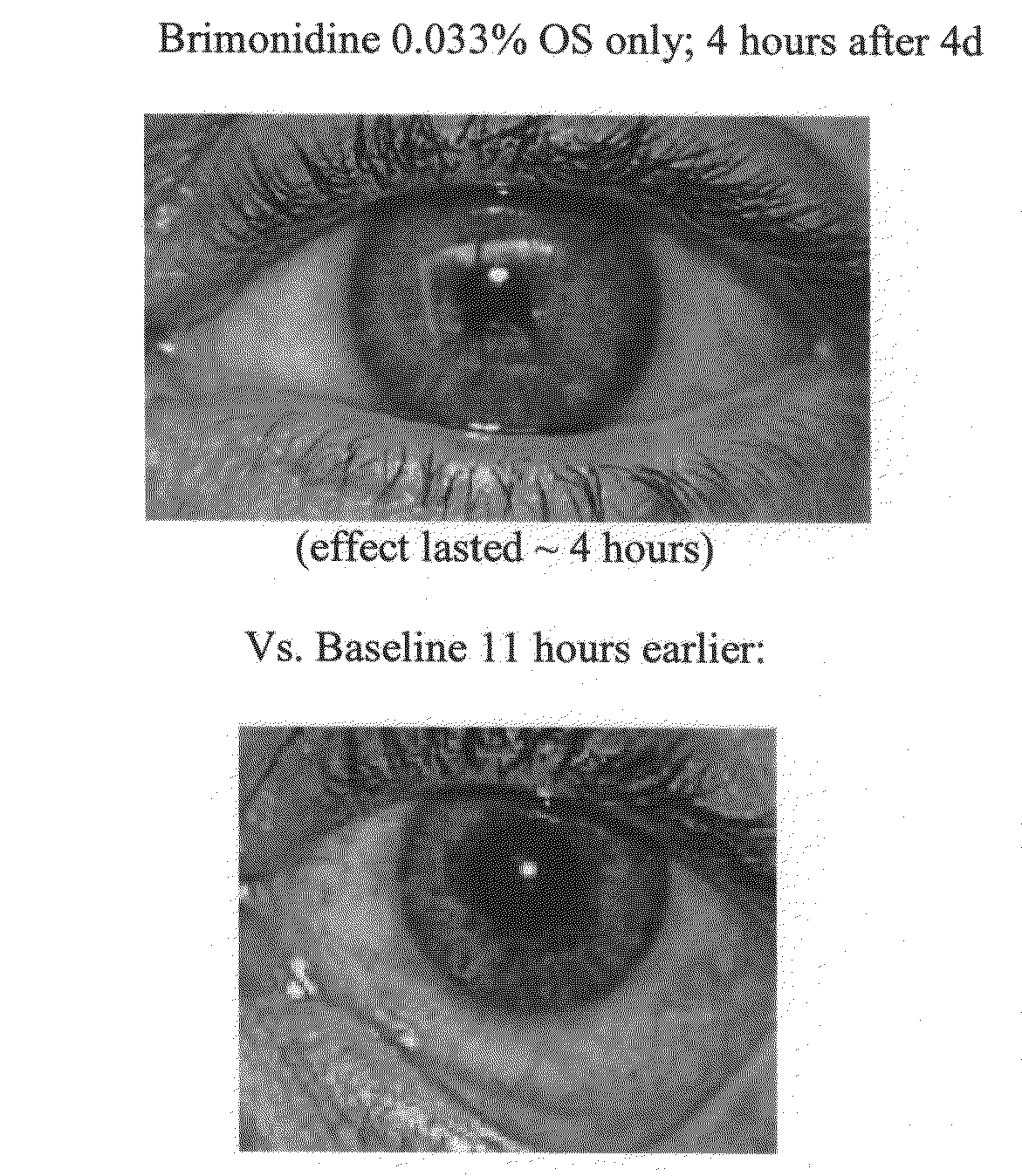 Vasoconstriction compositions and methods of use