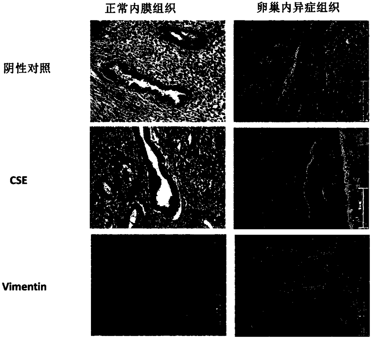 Application of hydrogen sulfide synthetase inhibitor PAG in preparation of medicines for treating endometriosis (EMS)