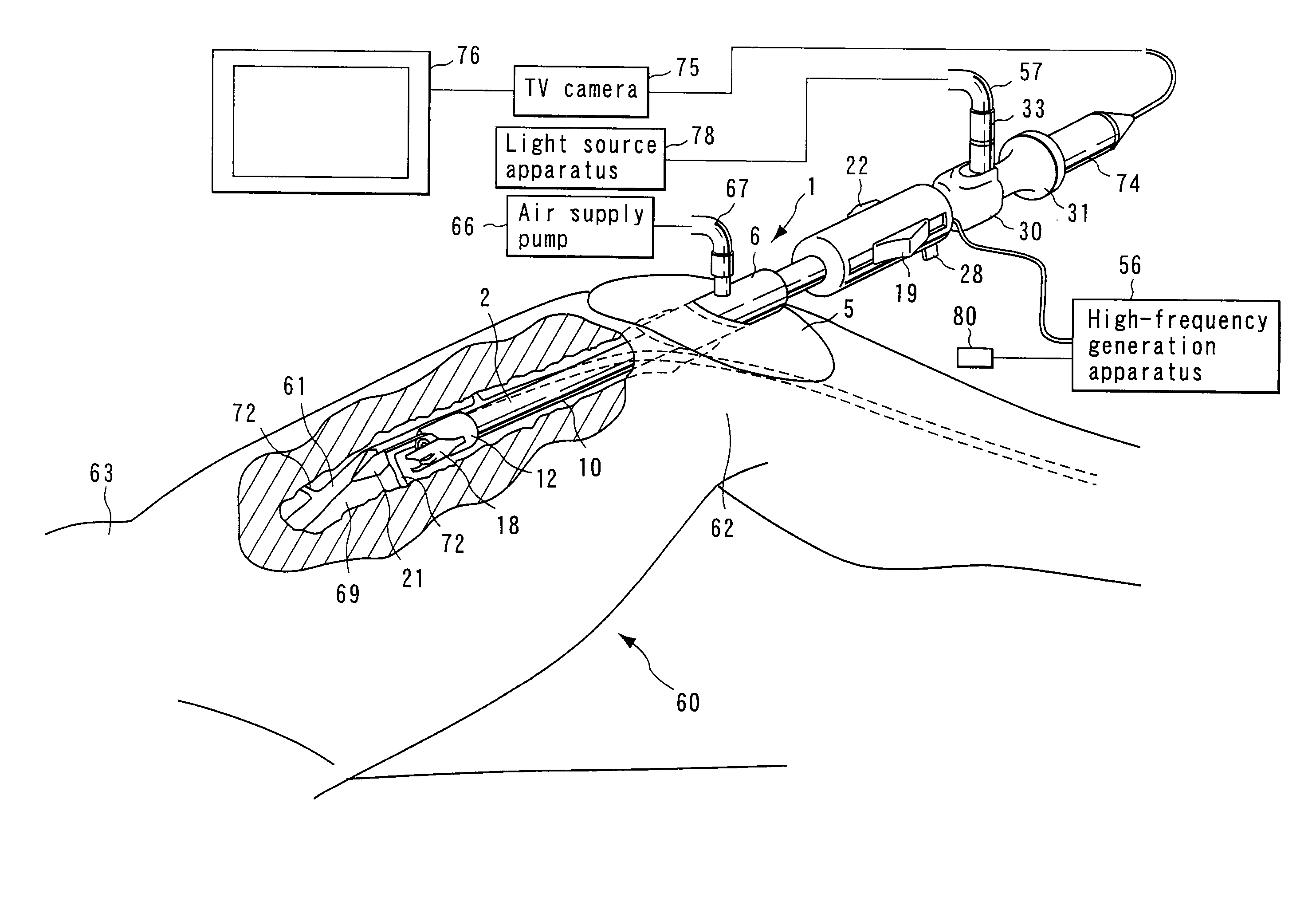 Treatment sheath for endoscopic blood vessel harvesting