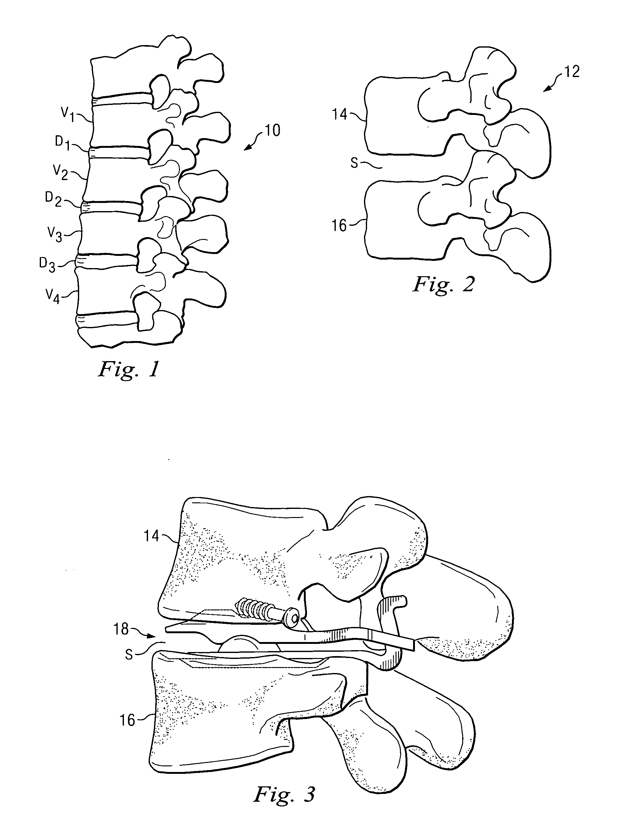 Posterior joint replacement device