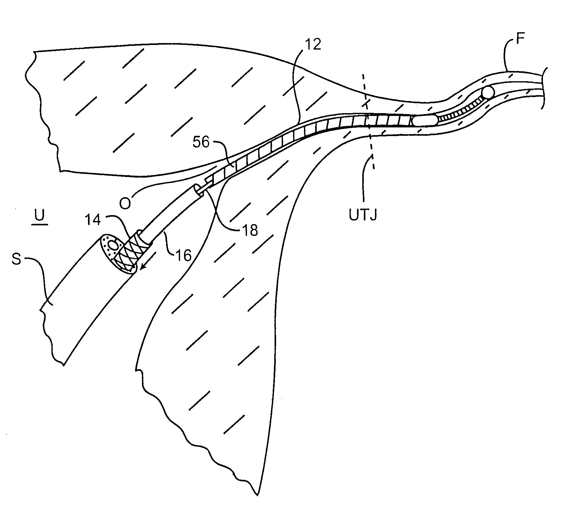 Insertion/deployment catheter system for intrafallopian contraception