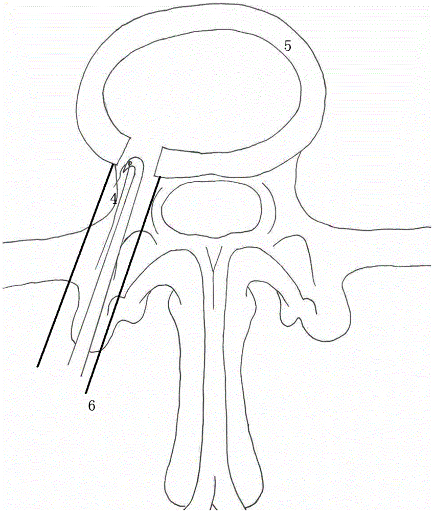 Fibrous ring stapler for percutaneous full-endoscopic minimally-invasive discectomy