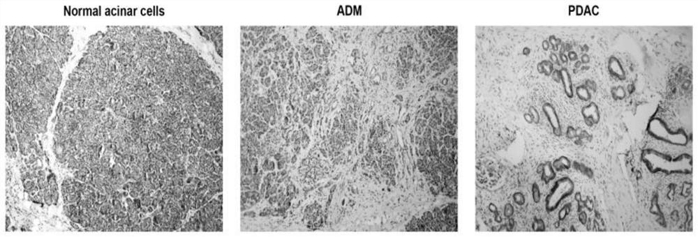 Application of PLD1 as molecular marker for evaluating sensitivity of tumor patients to chemotherapeutic drugs