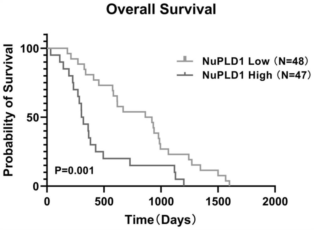 Application of PLD1 as molecular marker for evaluating sensitivity of tumor patients to chemotherapeutic drugs