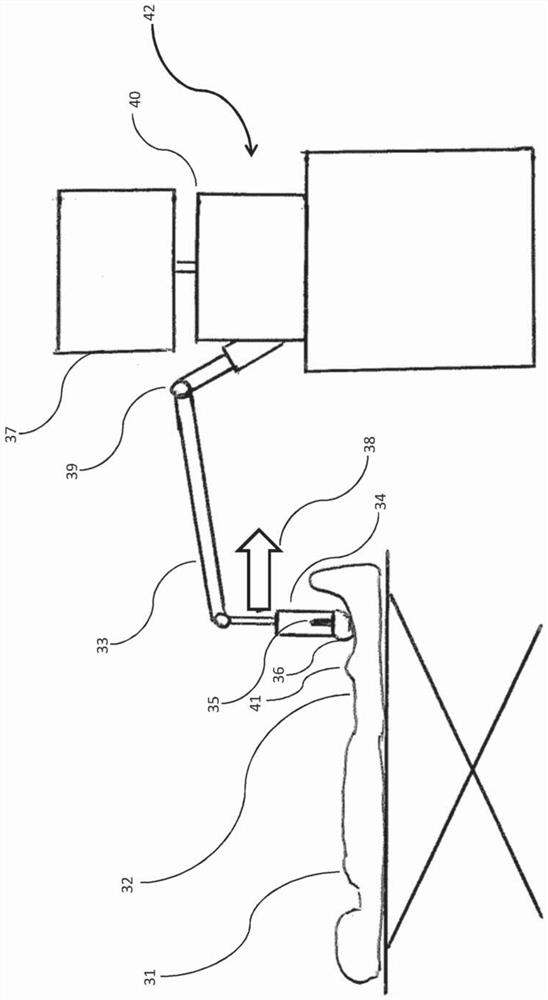 Method and device for treating varicose veins by application of high-intensity focused ultrasound