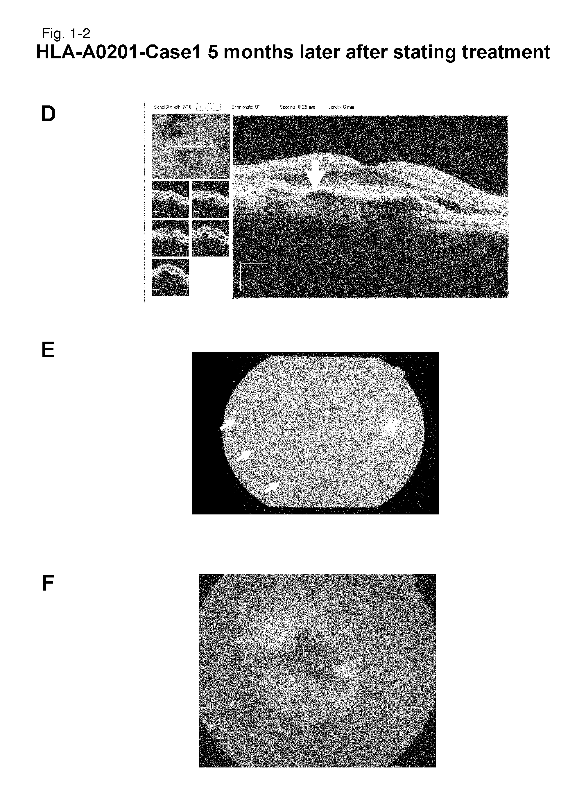 Methods for treating a disease caused by choroidal neovascularization