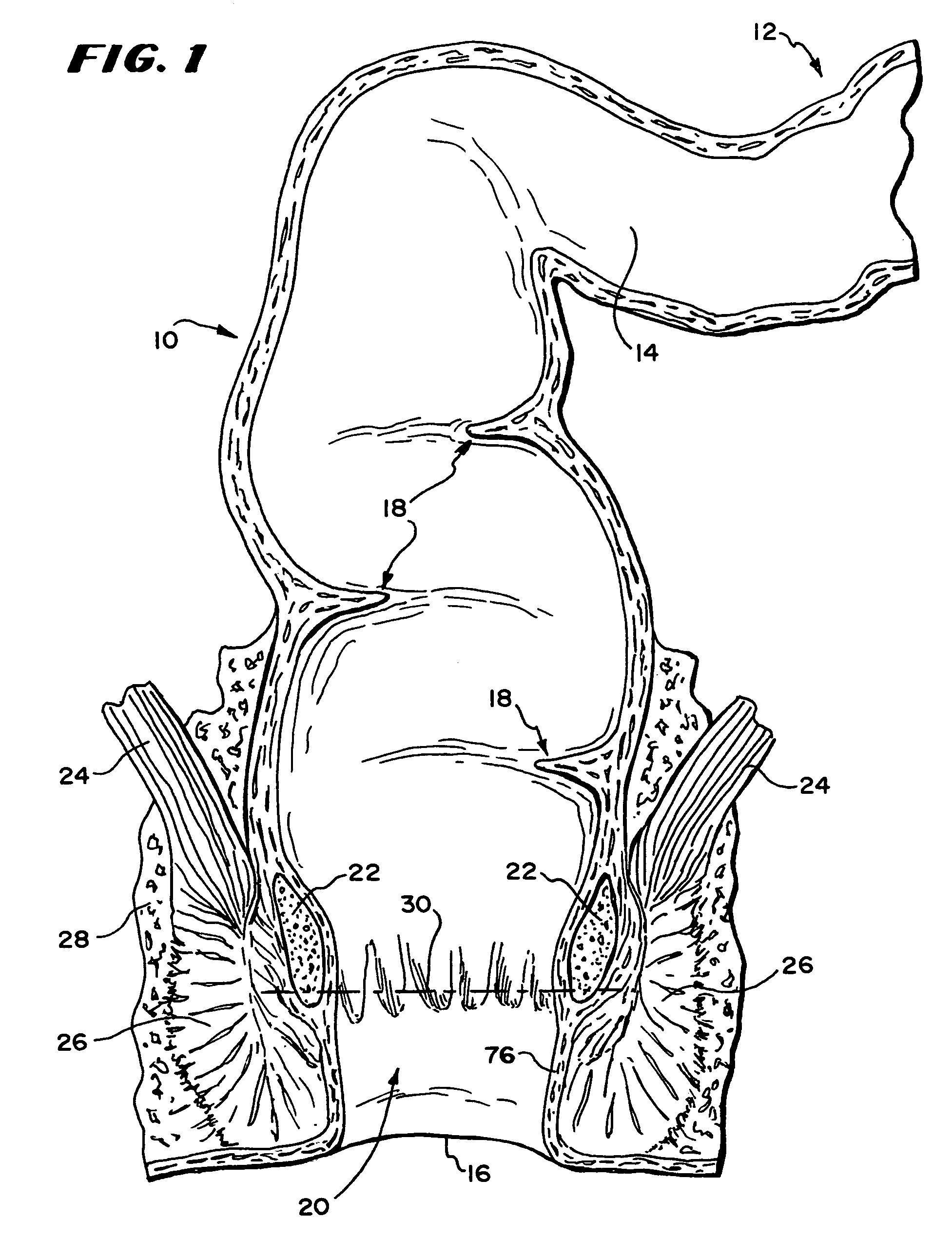 Systems and methods for treating dysfunctions in the intestines and rectum