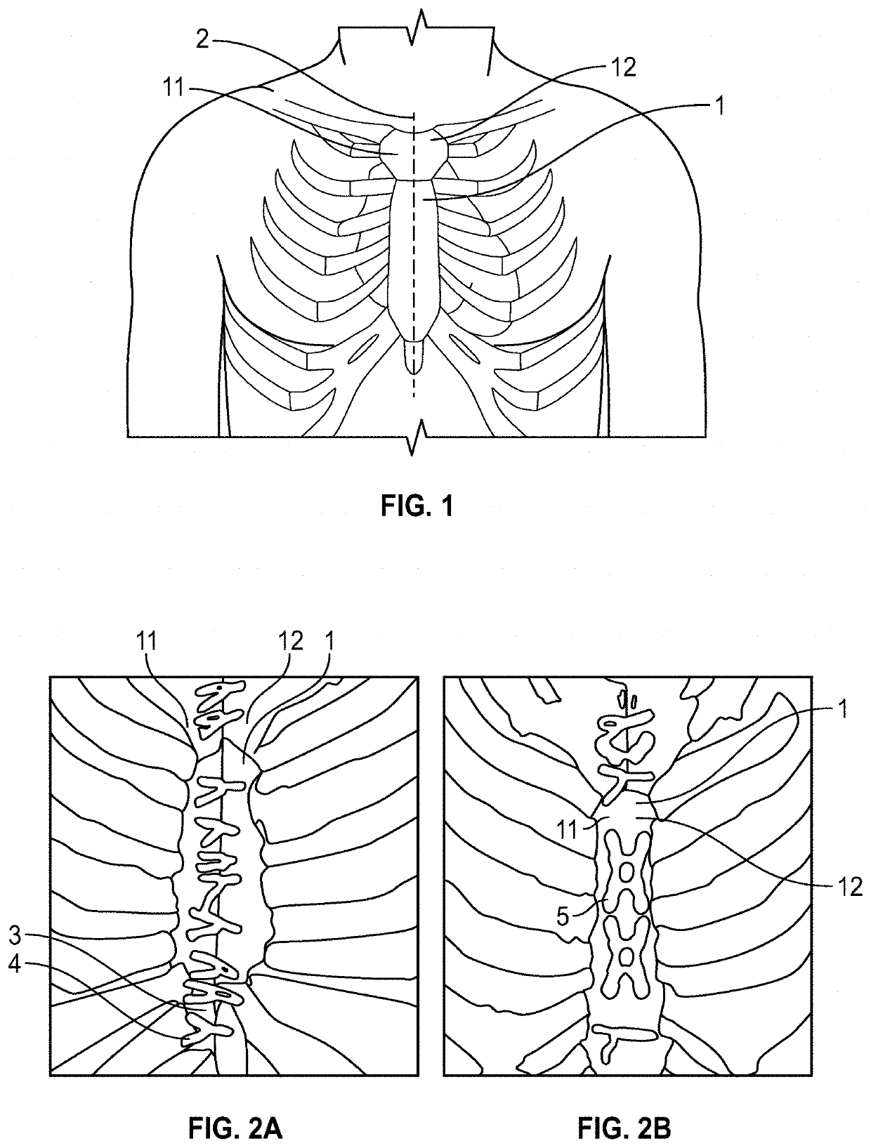 System and method to fuse bone