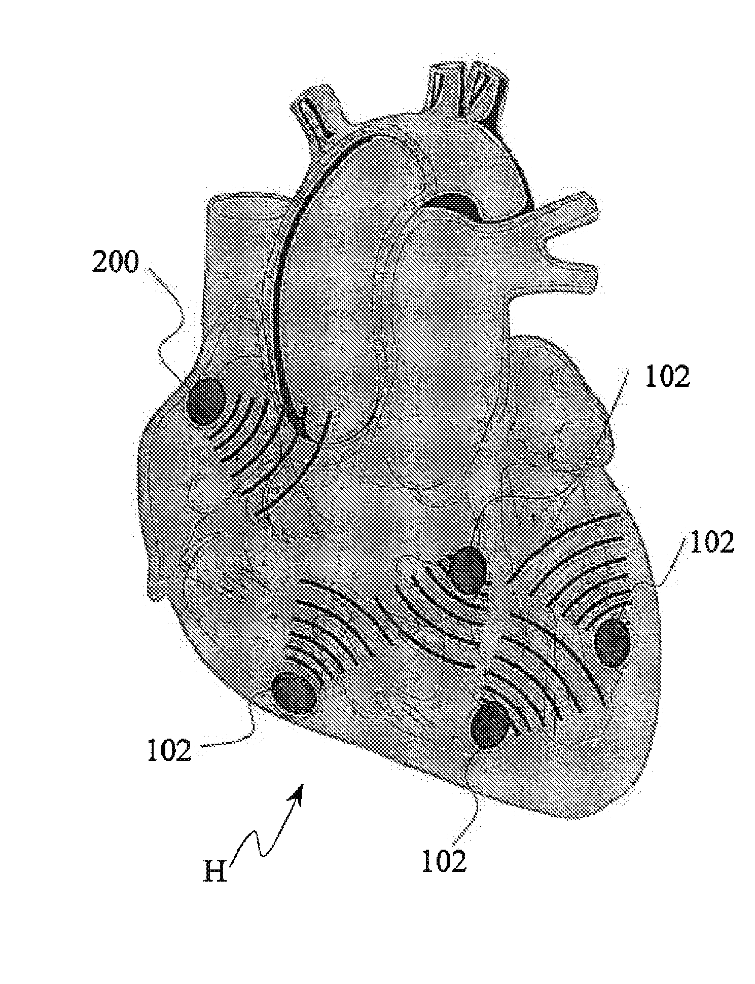 Cardiac pacing system and distributed cardiac pacing system