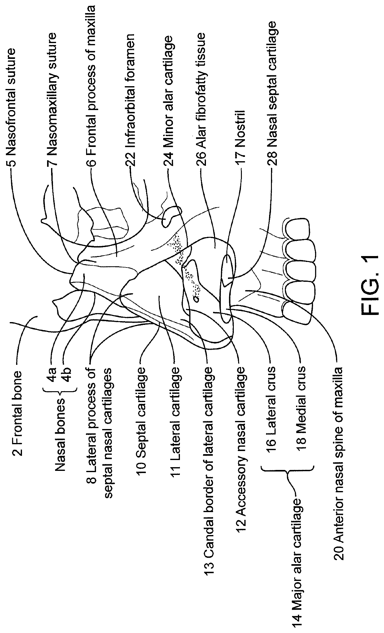 Nasal implants and systems and method of use