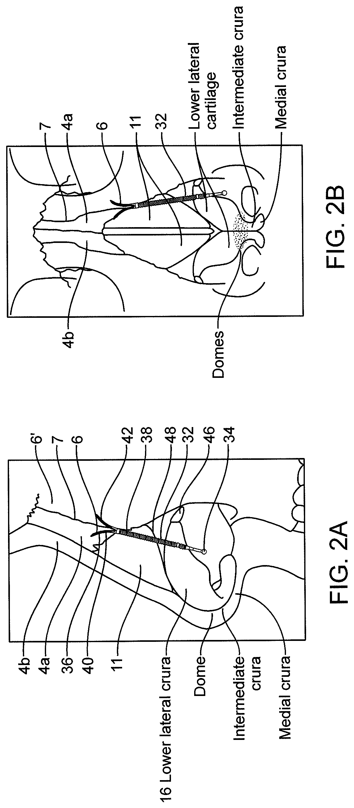 Nasal implants and systems and method of use