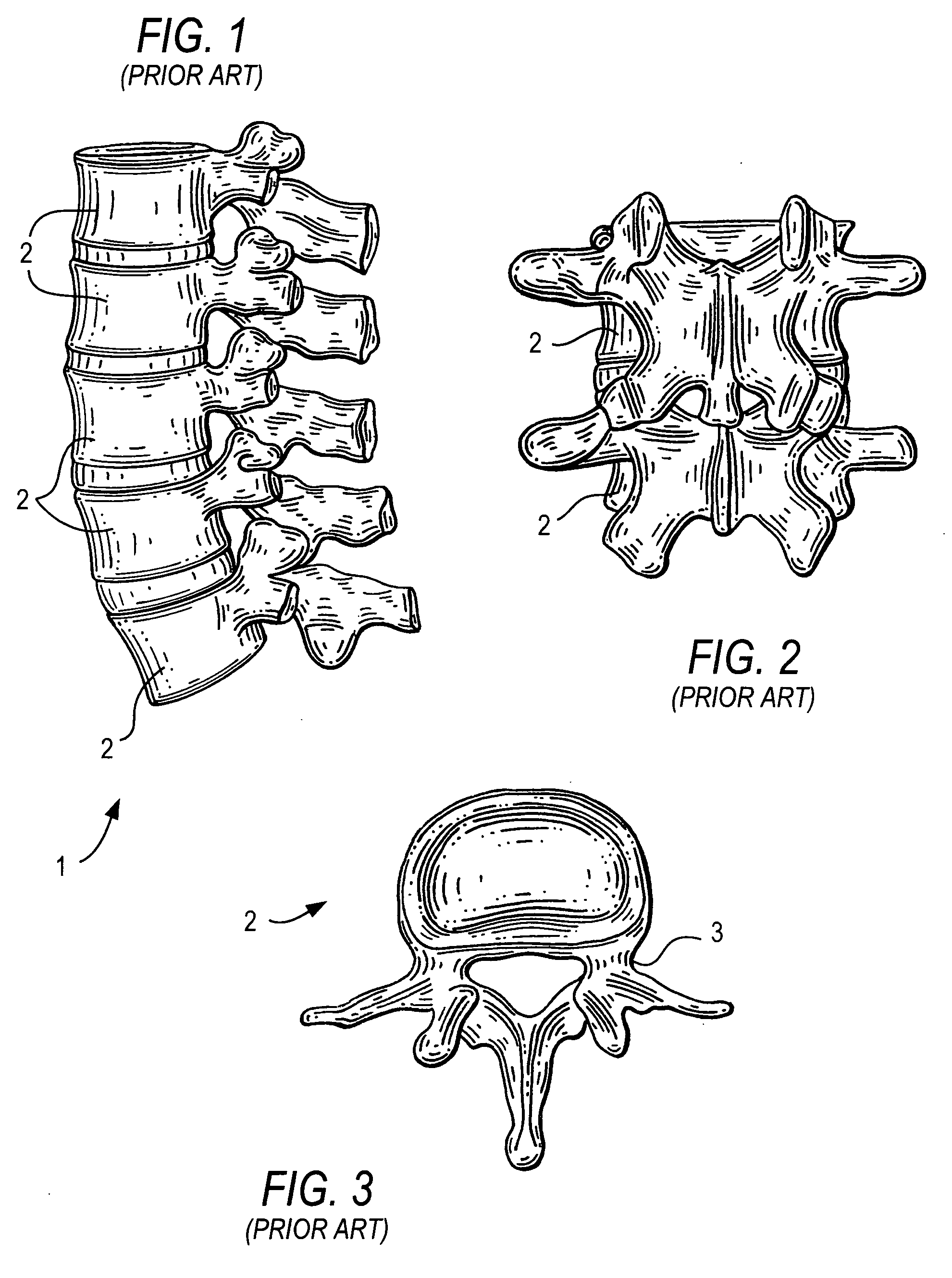 Guide pin for pedicle screw placement and method for use of such guide pin in spinal fusion surgeries