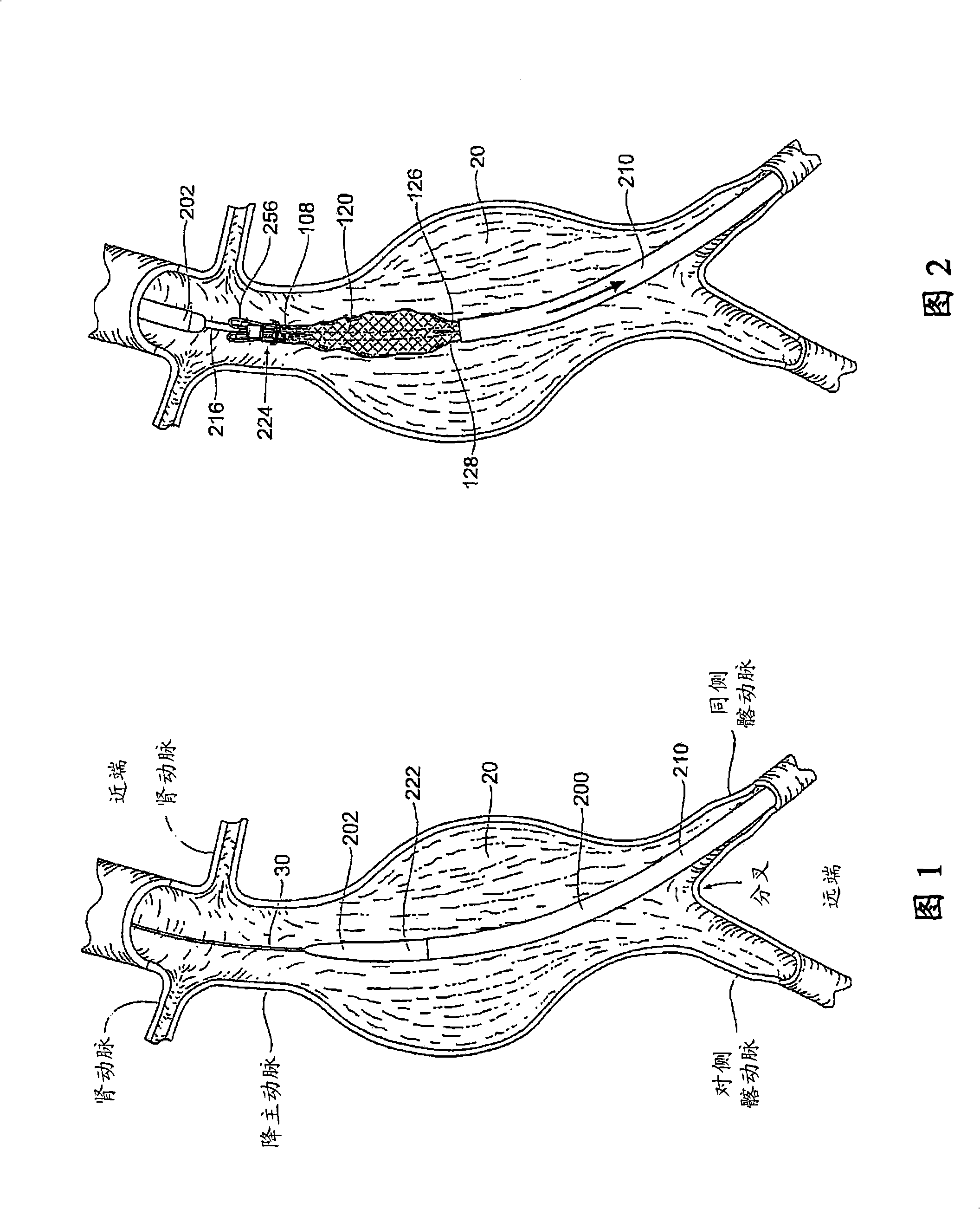 Devices, systems and methods for prosthesis delivery and implantation