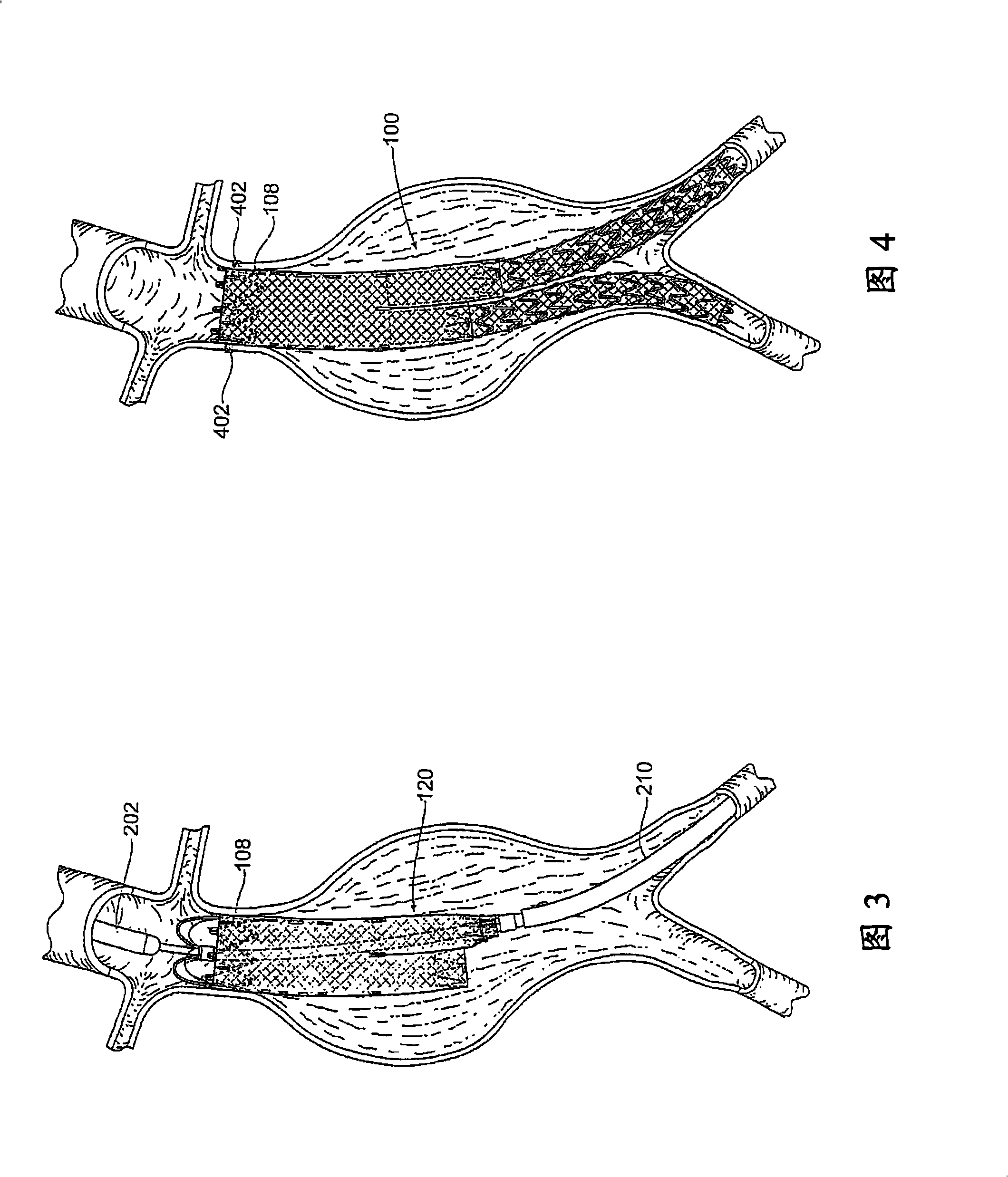 Devices, systems and methods for prosthesis delivery and implantation