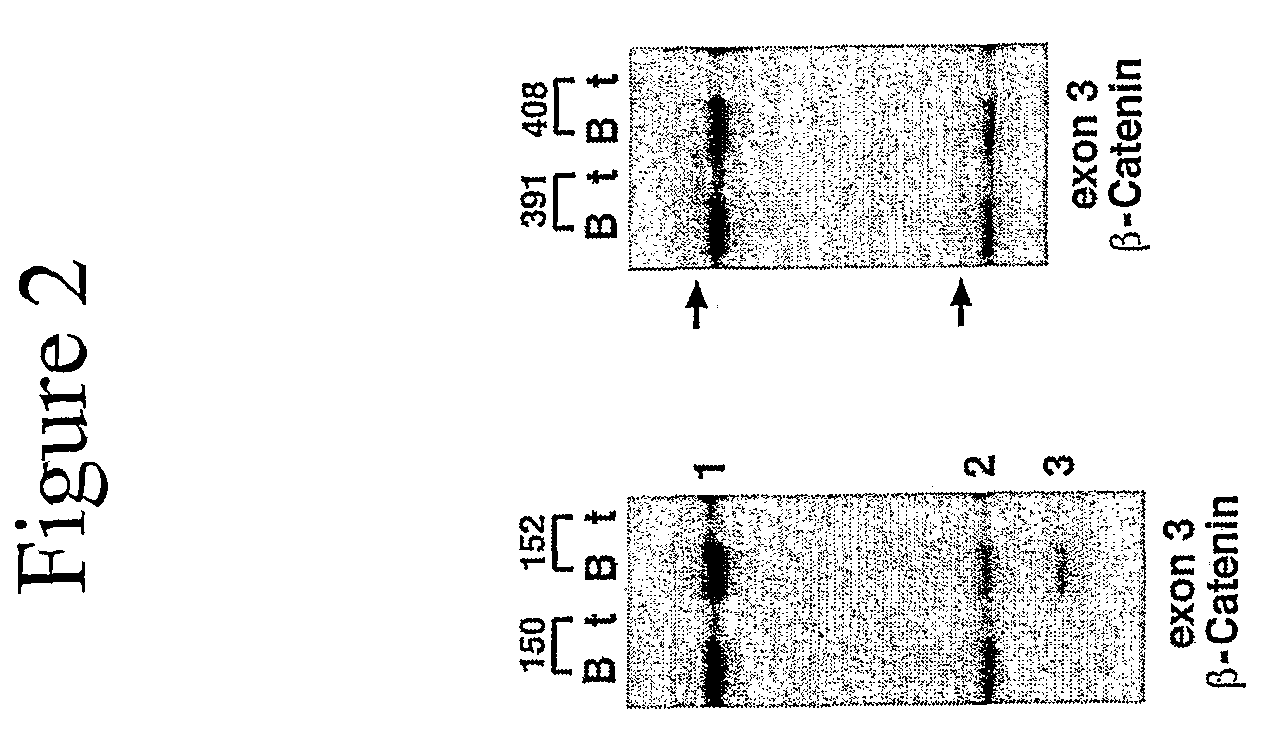 Method of diagnosing and treating cancer using b-catenin splice variants