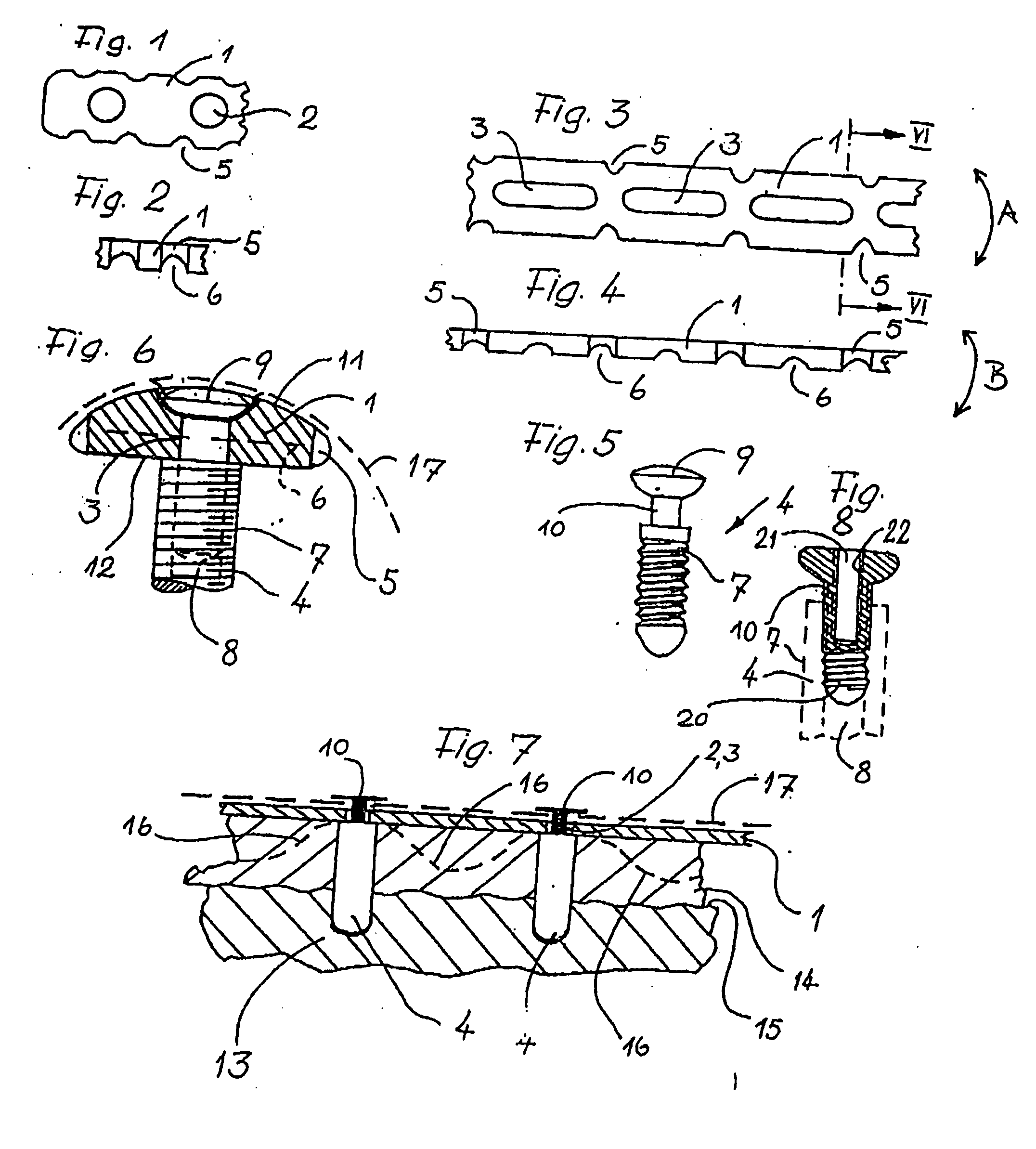 Device for regenerating, repairing, and modeling human and animal bone, especially in the jaw area for dental applications