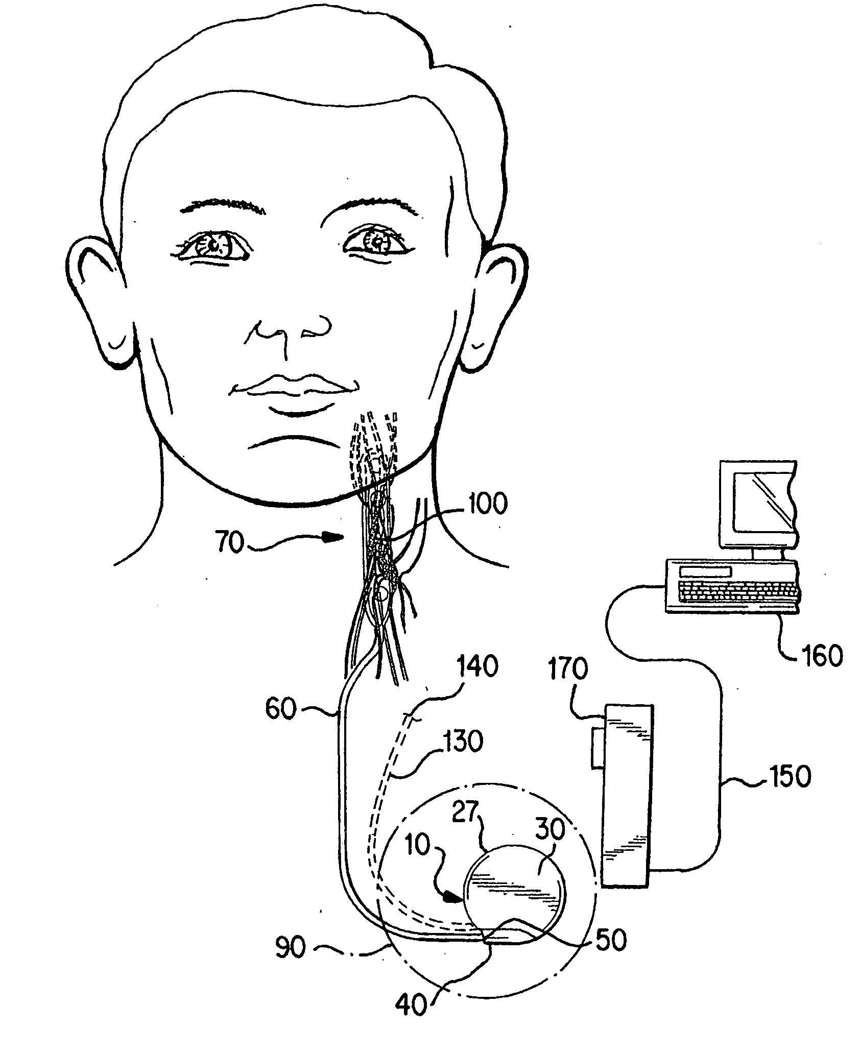 Nerve stimulation for treatment of syncope