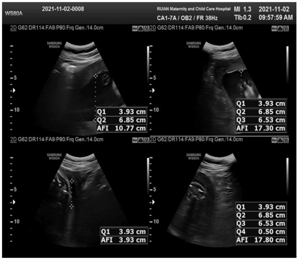 Method for intelligently reminding whether fetal growth parameters are abnormal or not through ultrasonic measurement