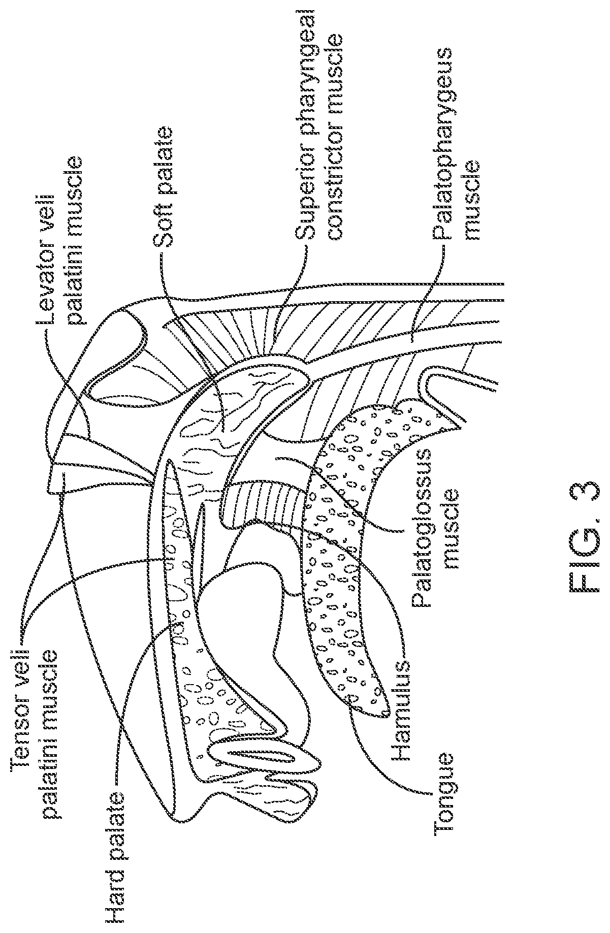 Soft palate treatment