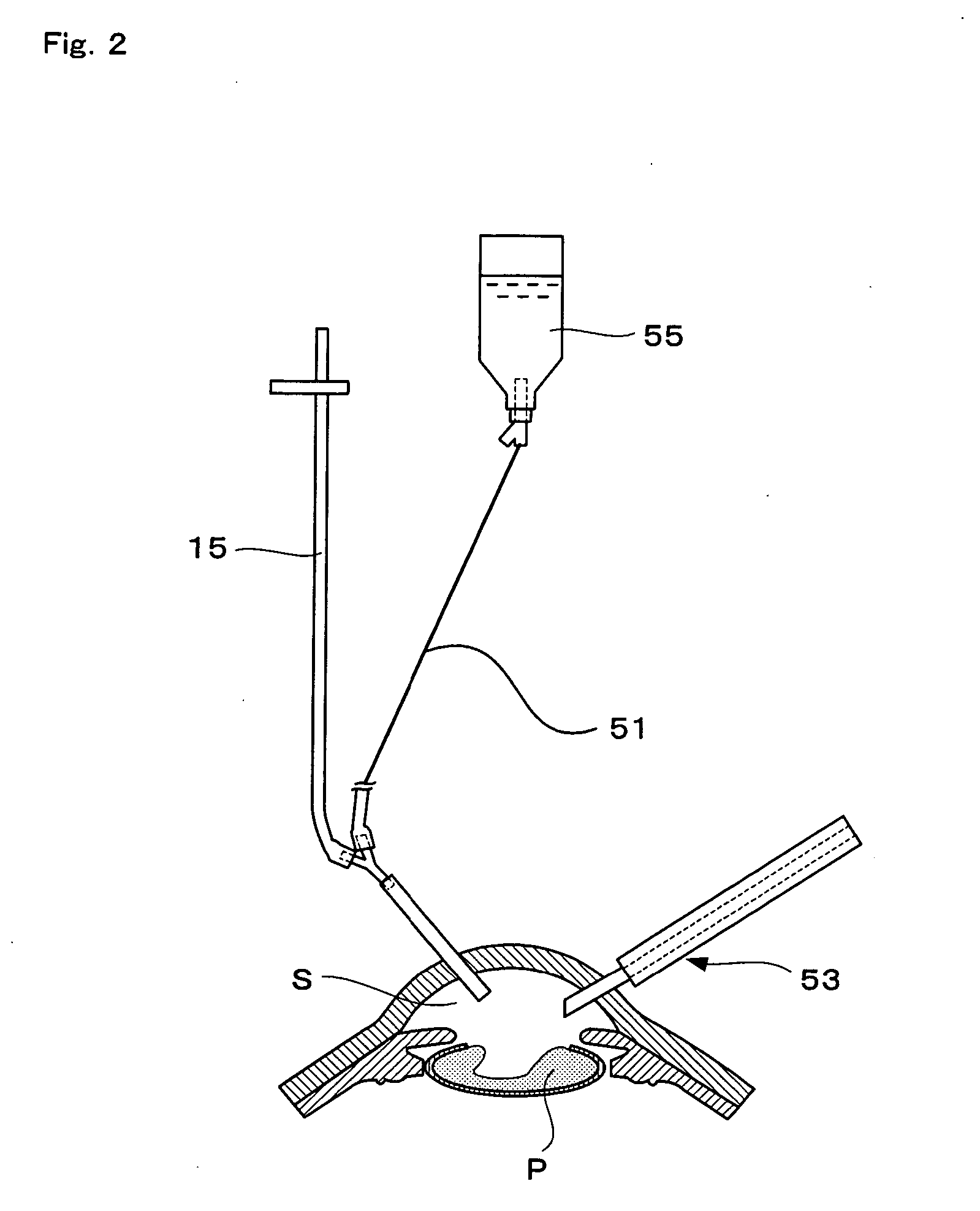 Decompression-compensating instrument for ocular surgery, instrument for ocular surgery provided with same and method of ocular surgery