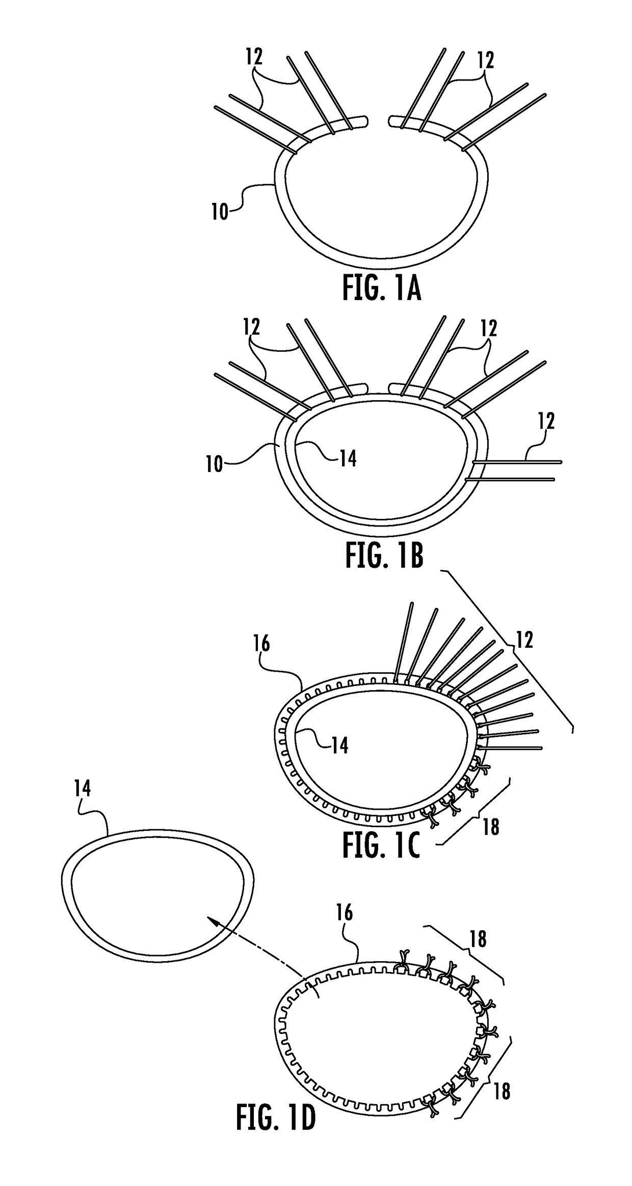 Prosthetic device for heart valve reinforcement and remodeling procedures